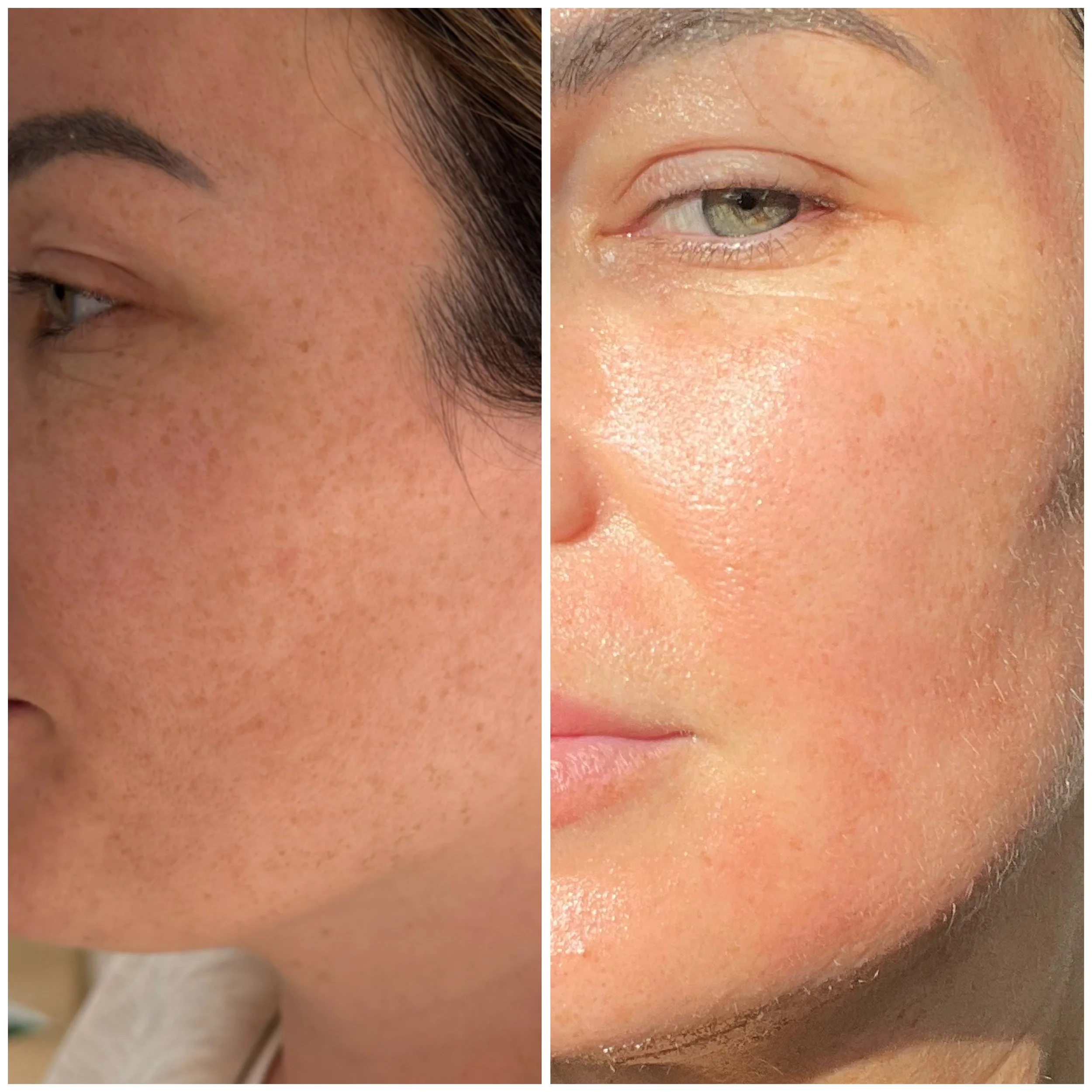 Microneedling Before and After 