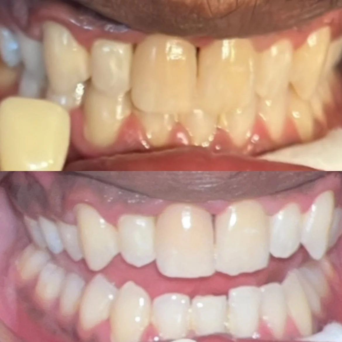 Teeth Whitening Service