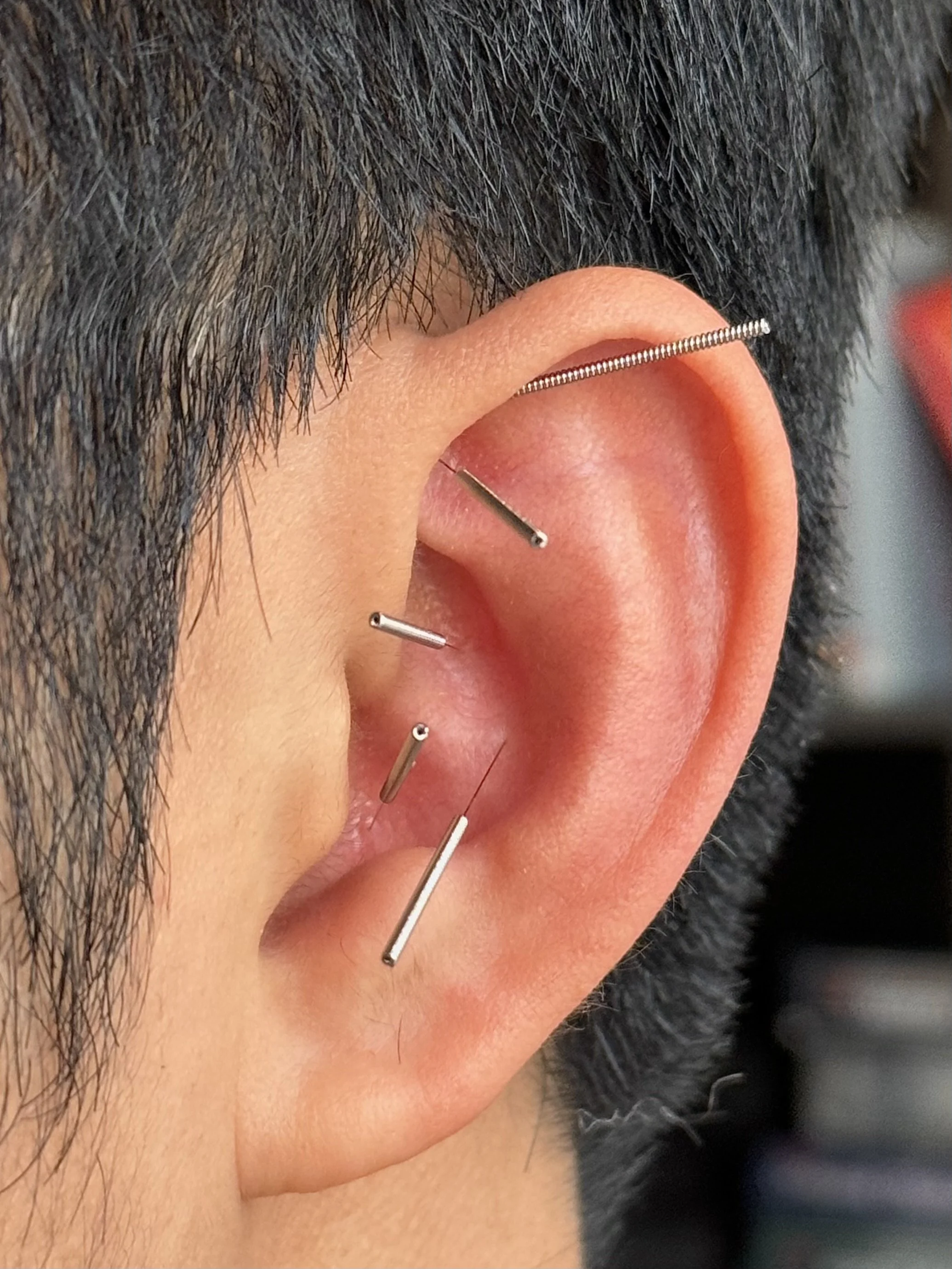 Acupuncture for Shoulder Pain: 7 Proven Benefits