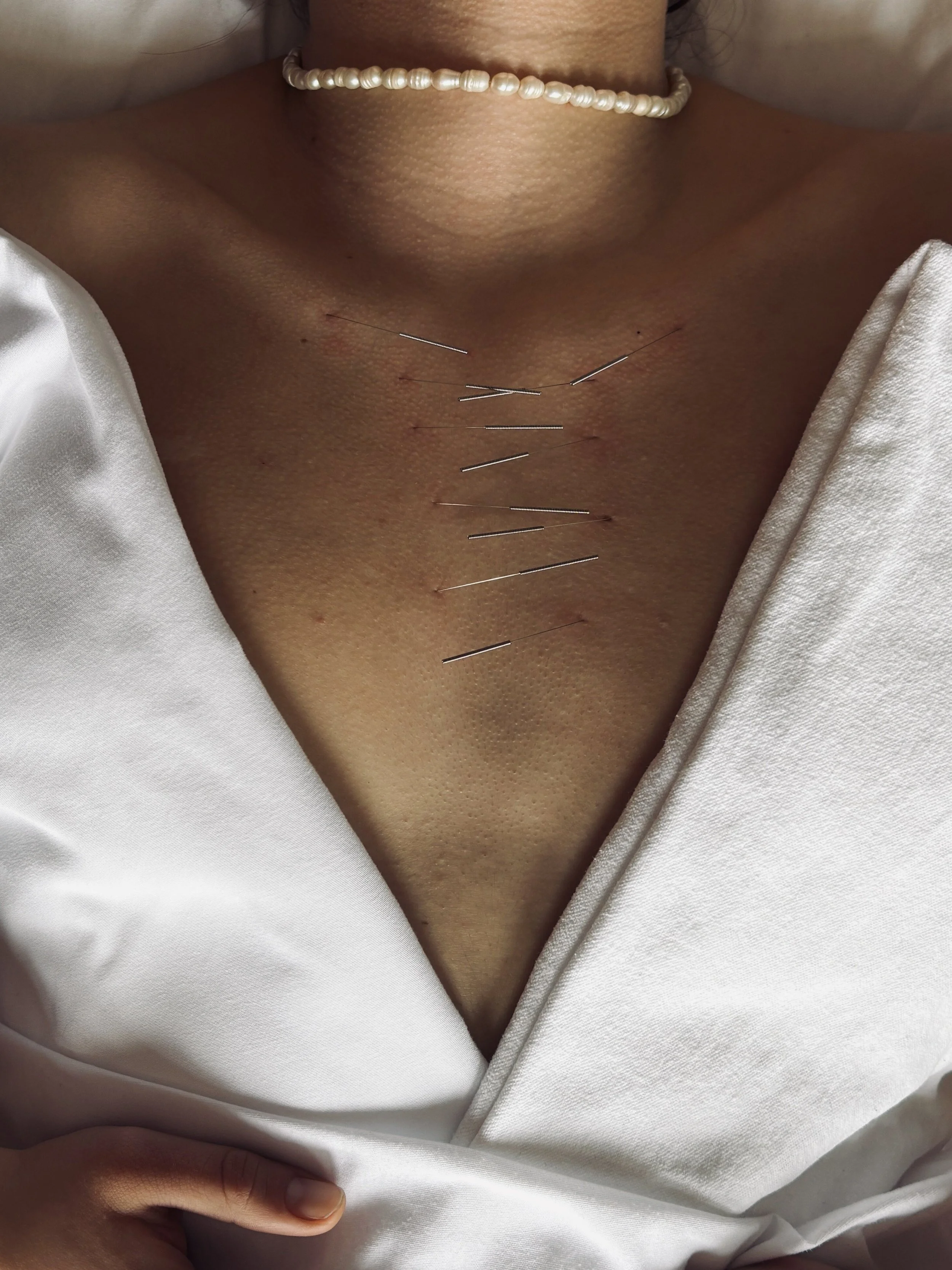 Acupuncture treatment on chest showing benefits for pain relief at Flow State Healing in Tofino