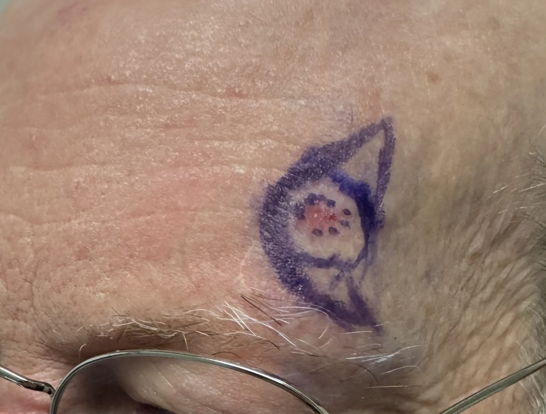 BCC of the forehead eminence