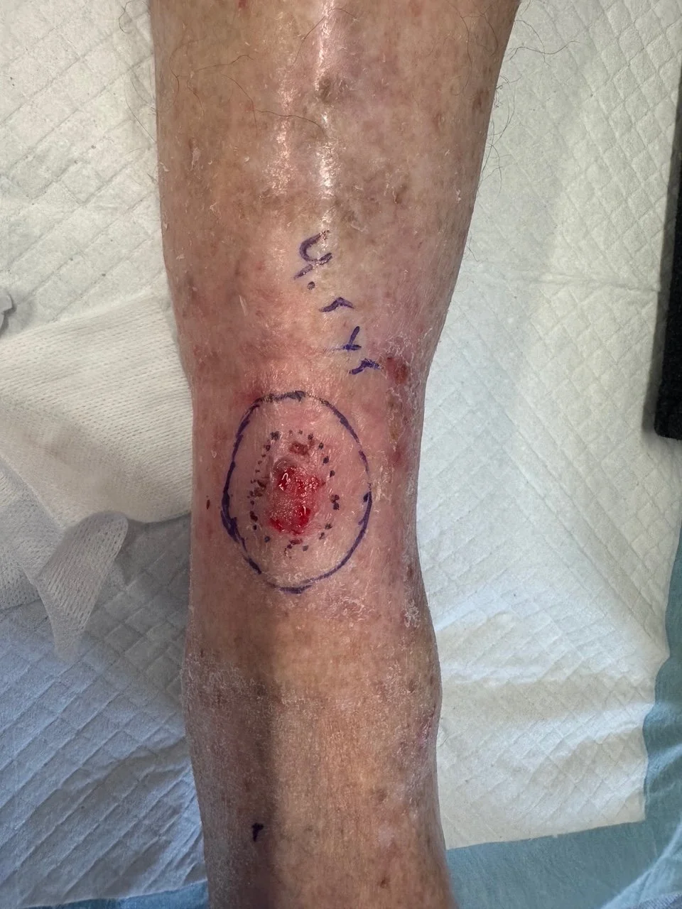Infiltrative BCC right leg