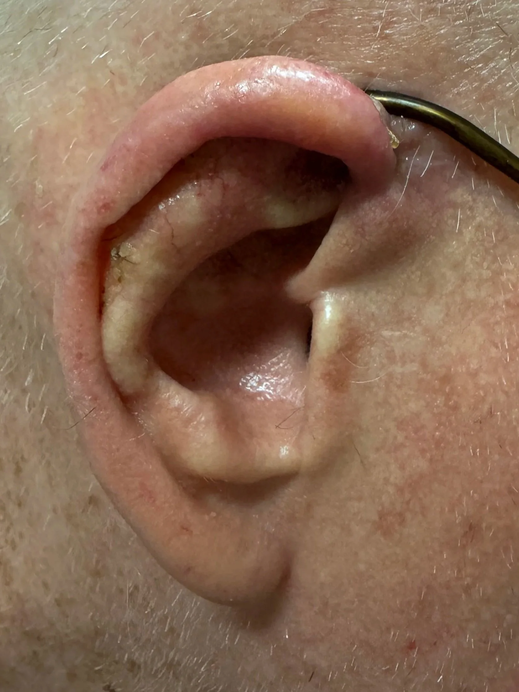 Appearance of ear 9 weeks after procedure