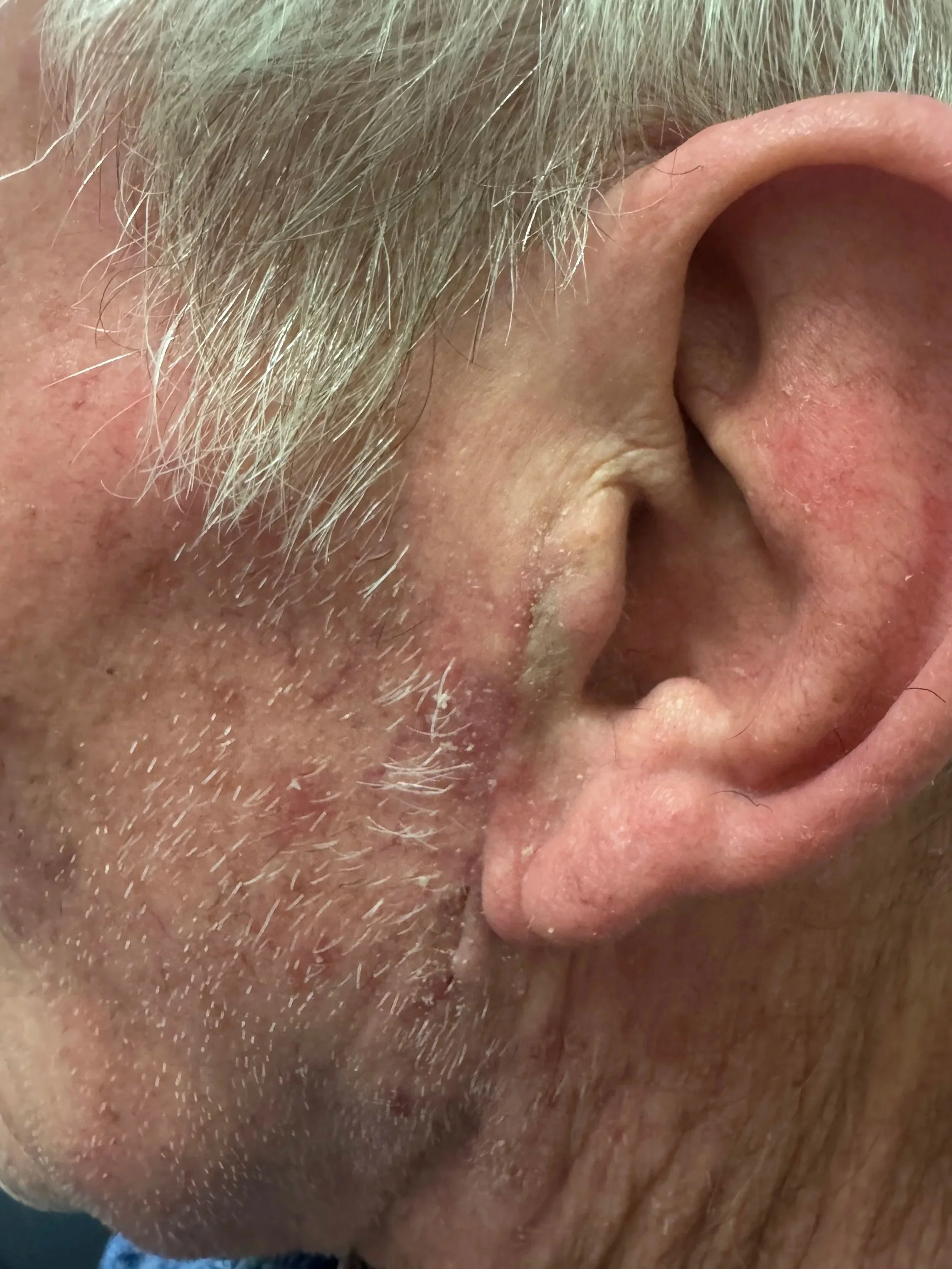 Appearance of scar 2 weeks after removal of SCC