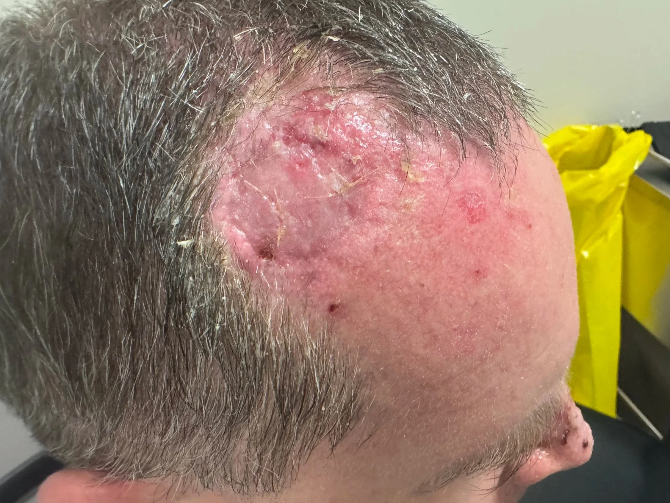 Appearance of skin graft after 5 weeks