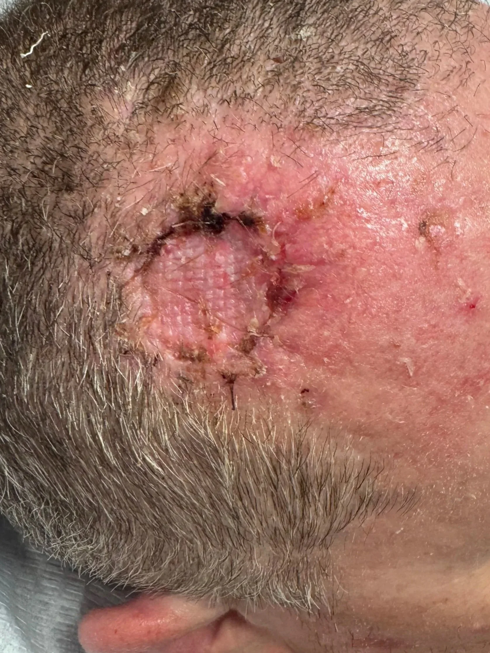 2 weeks after excision of SCC and skin graft