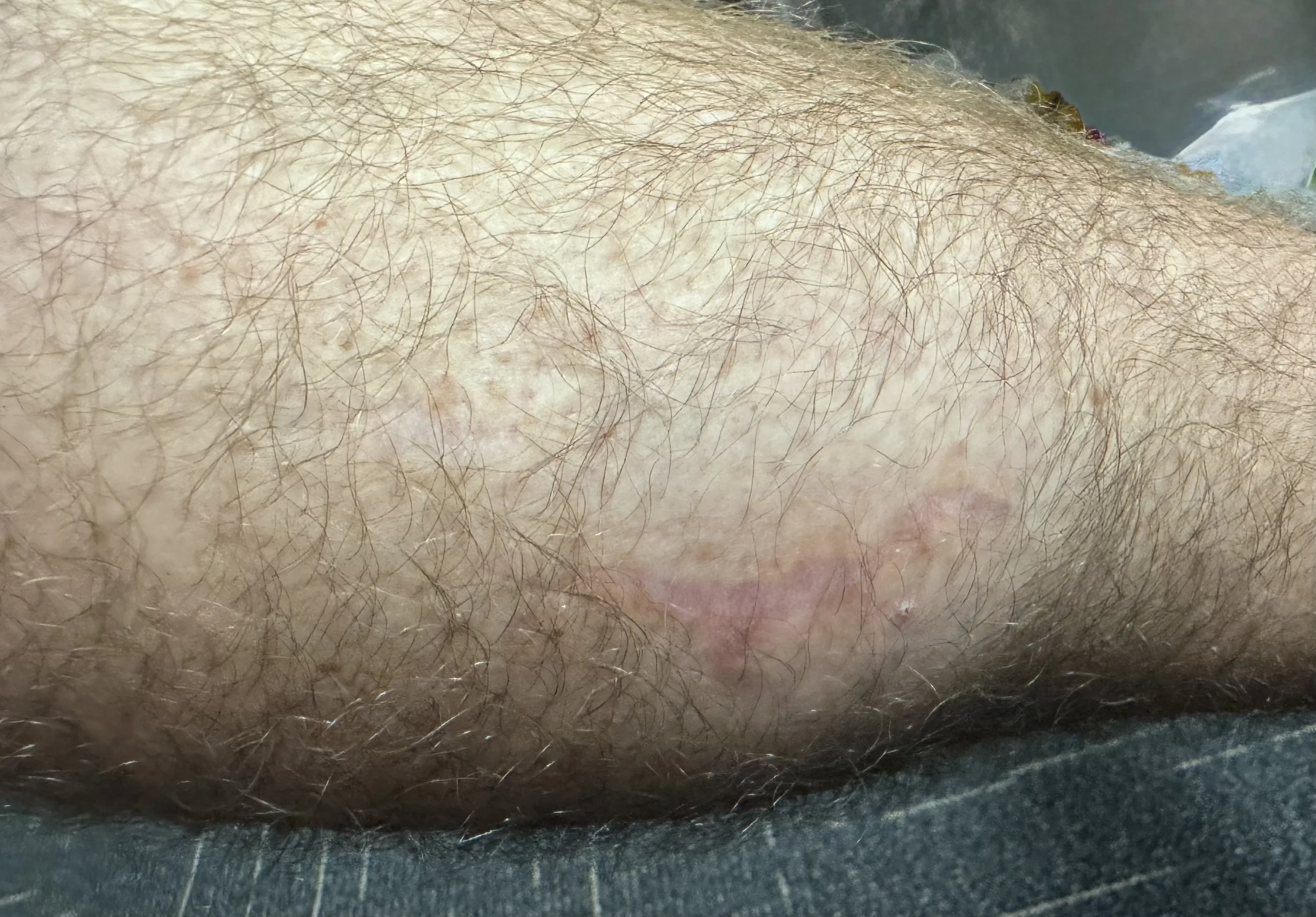Appearance of leg scar 7 months after repair