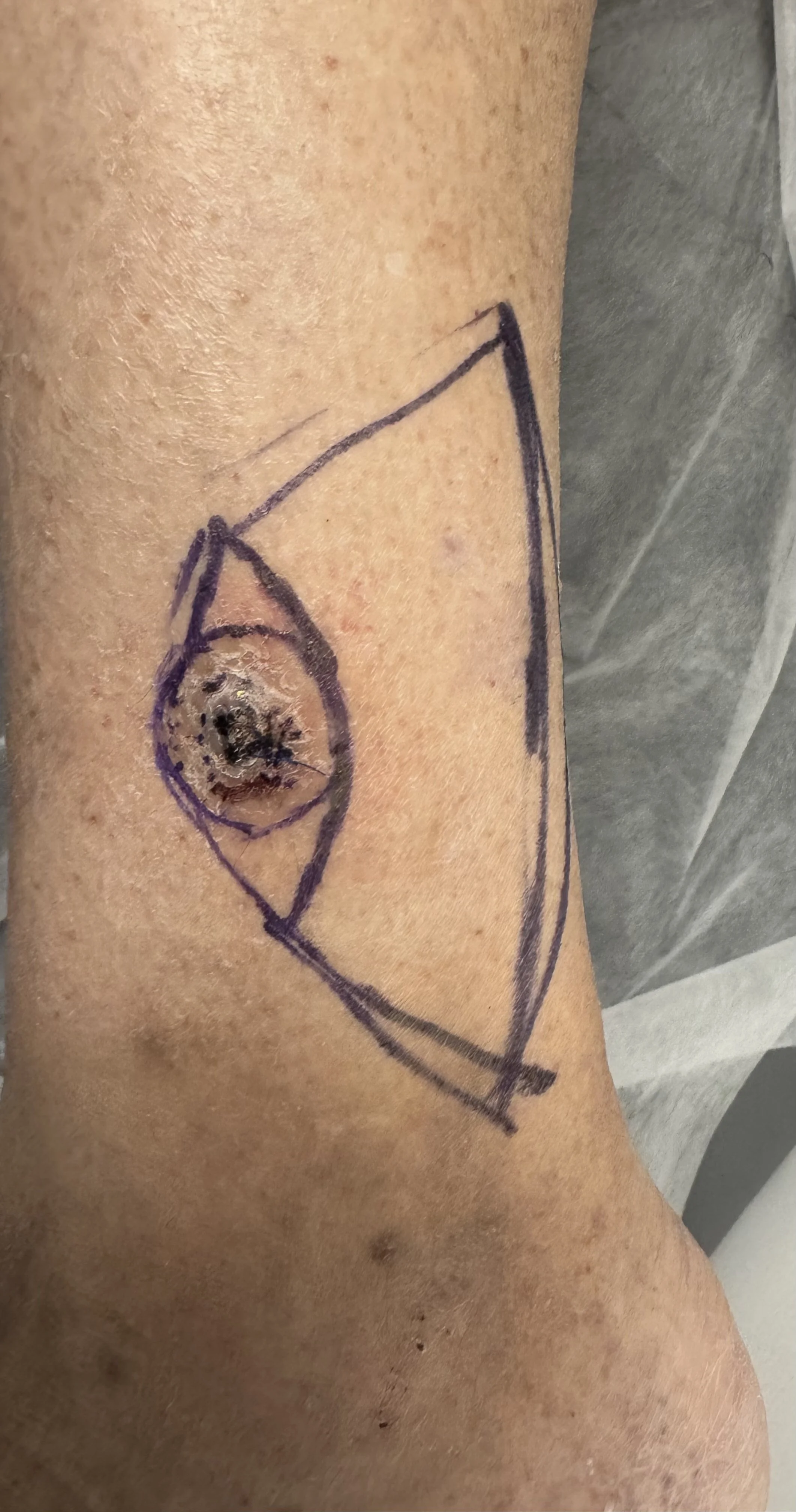 SCC Lateral leg