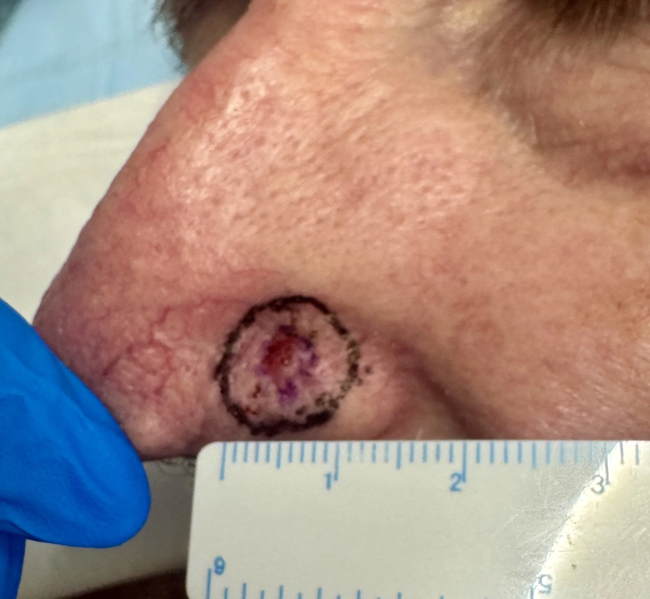 BCC  left nasal ala