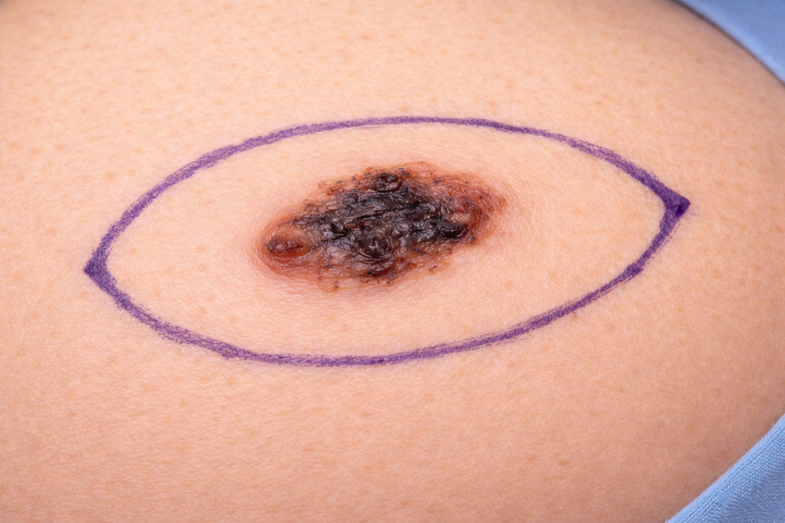 Suspicious skin lesion marked for assessment during skin cancer check Sydney