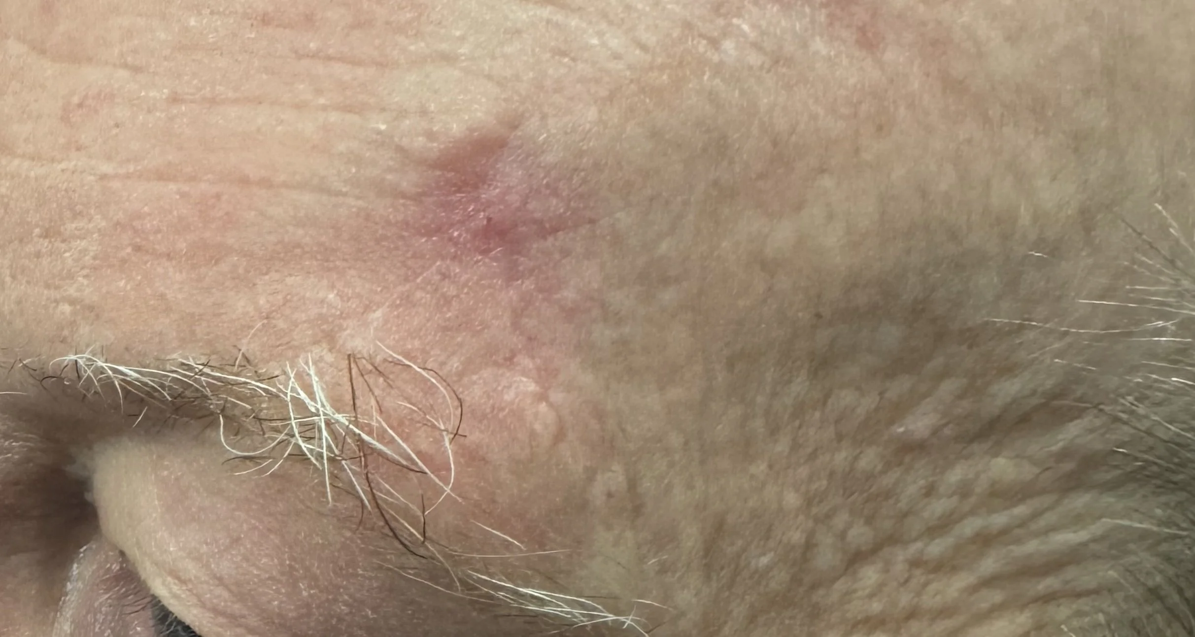 Appearance of scar 6 weeks after excision of BCC
