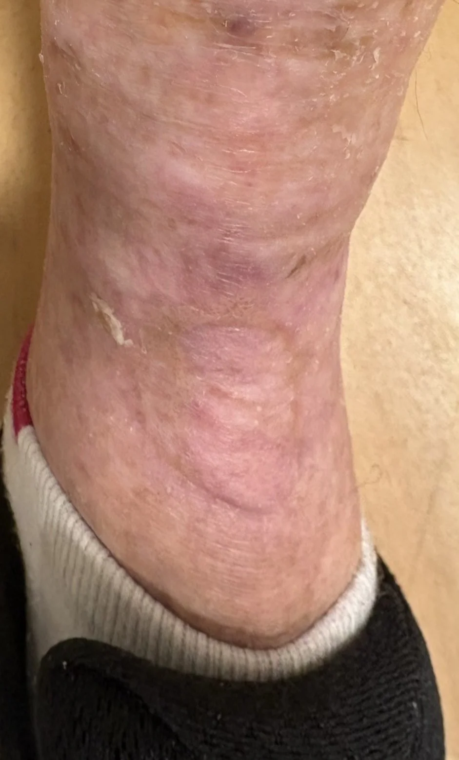 Appearance of leg 11 months after procedure