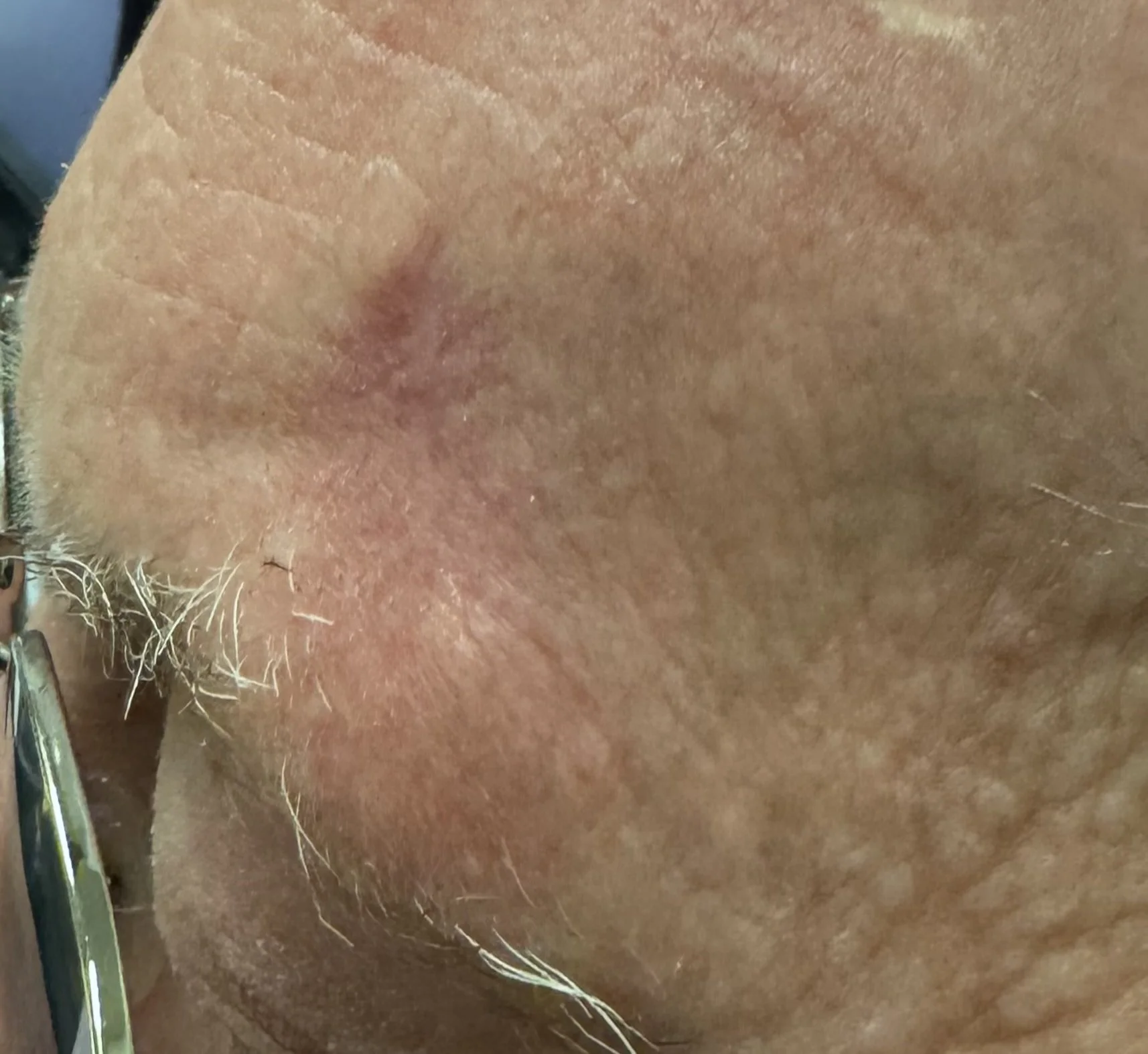 Appearance of scar at 3 months
