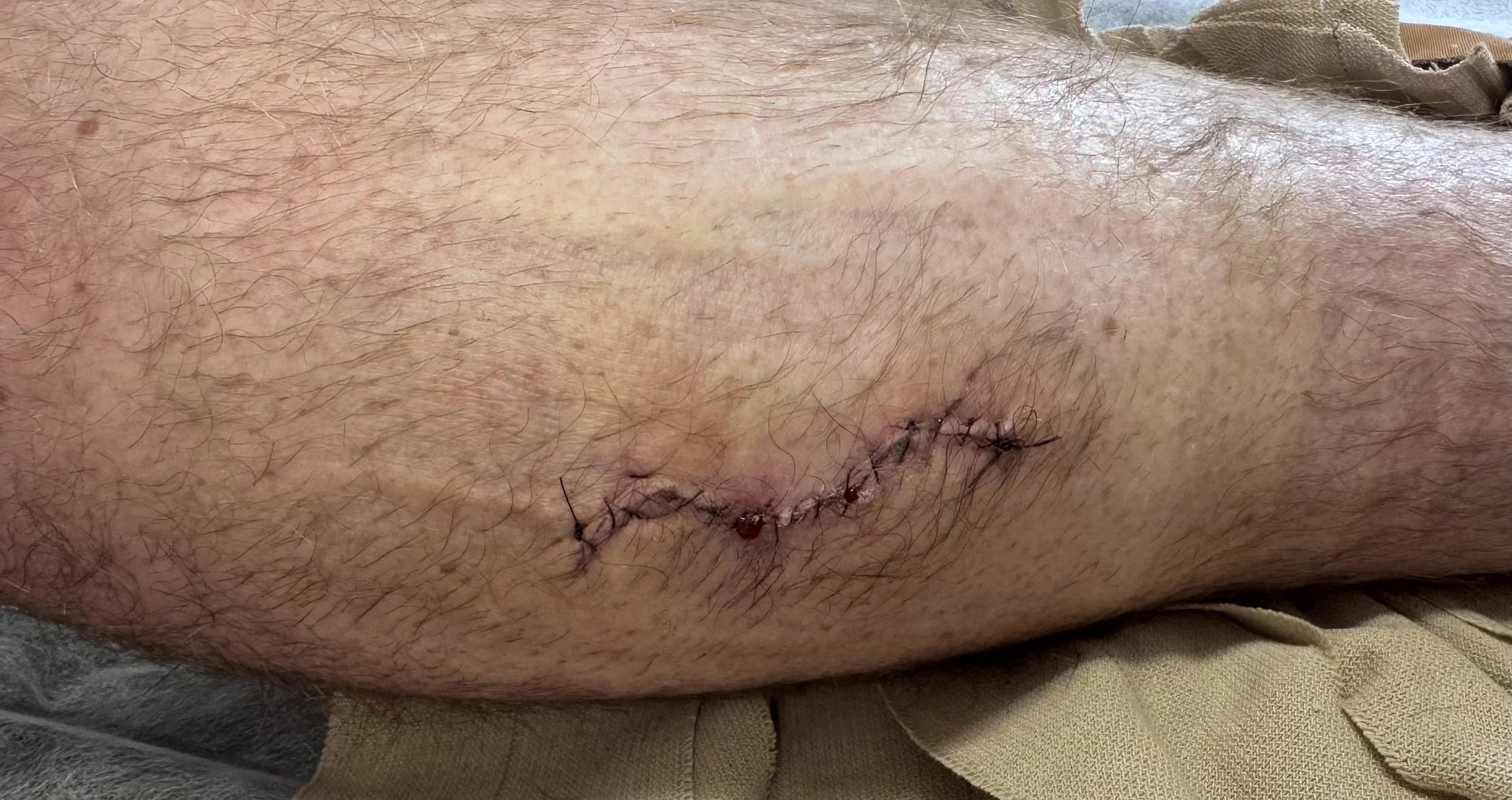 Appearance of leg wound 1 week after exploration and repair