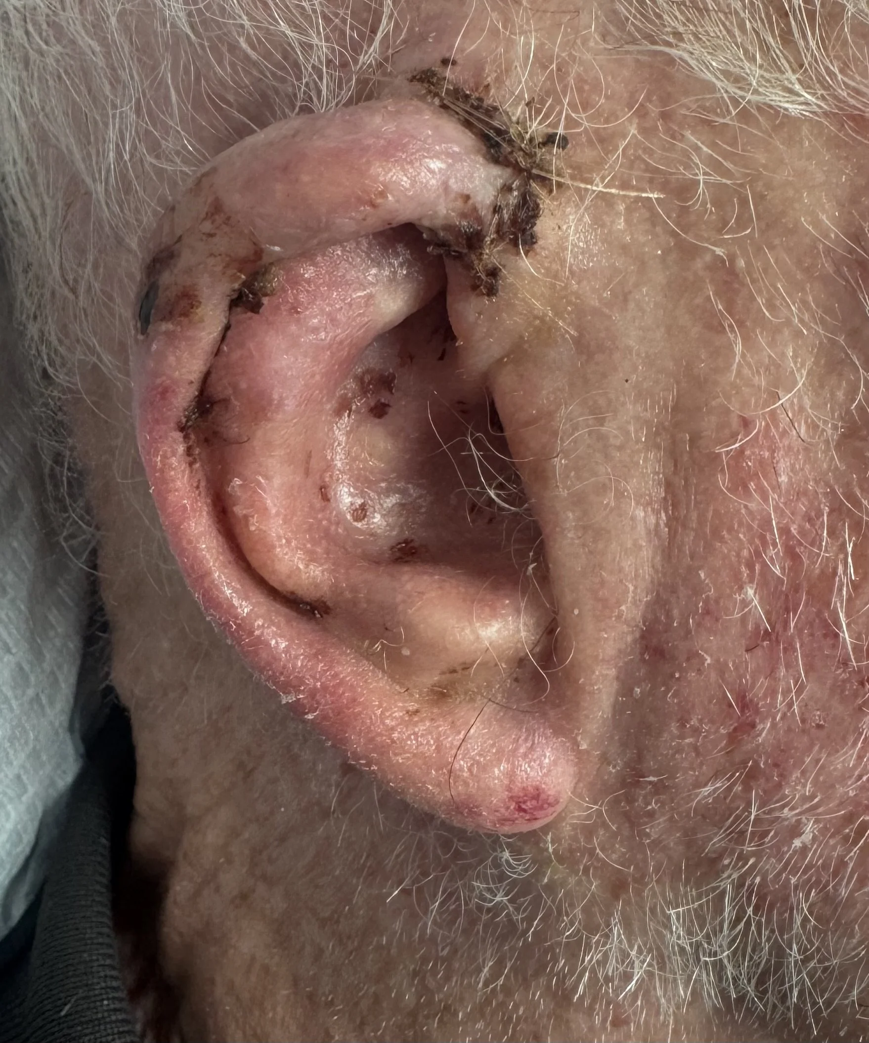 Appearance of ear 4 weeks after excision of SCC and flap procedure. Wound scab is common at this stage