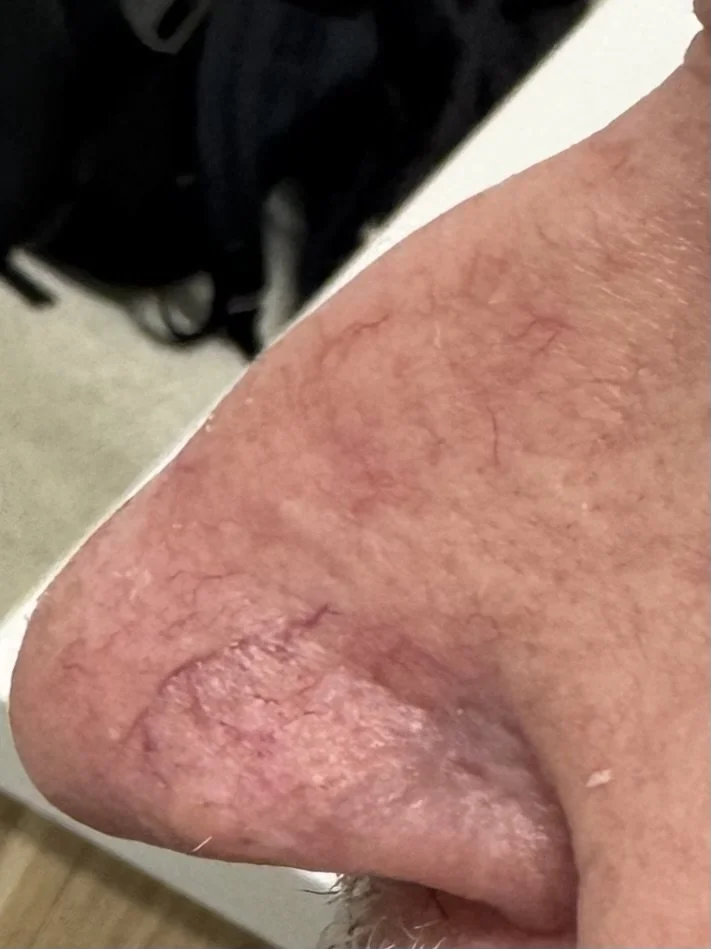 Appearance of skin graft after 7 weeks