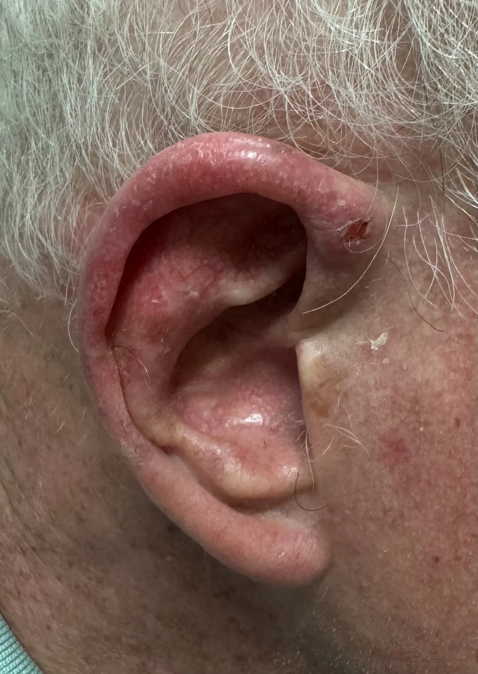 Moderately differentiated SCC of root of helix