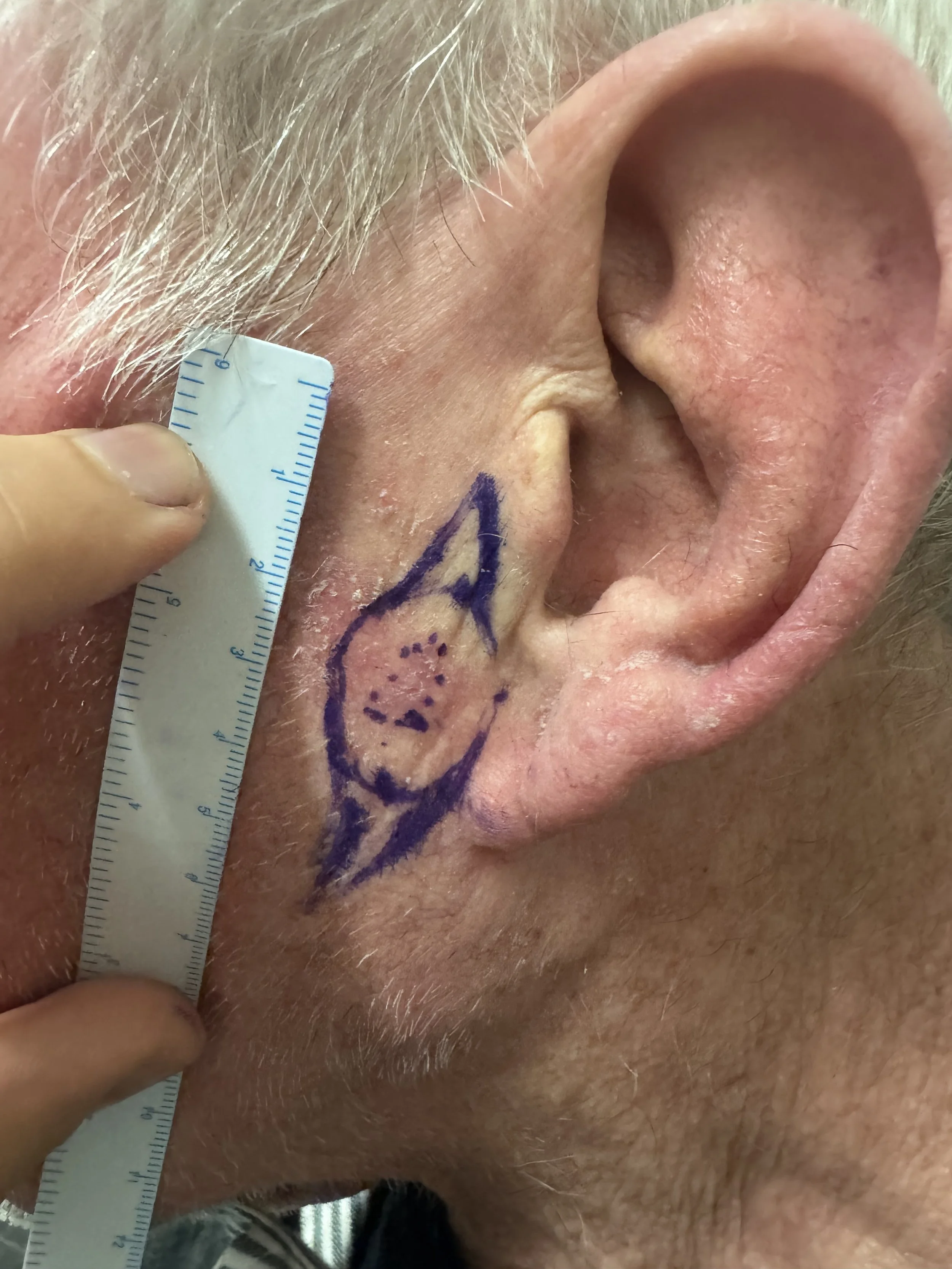 Left facial (preauricular) SCC