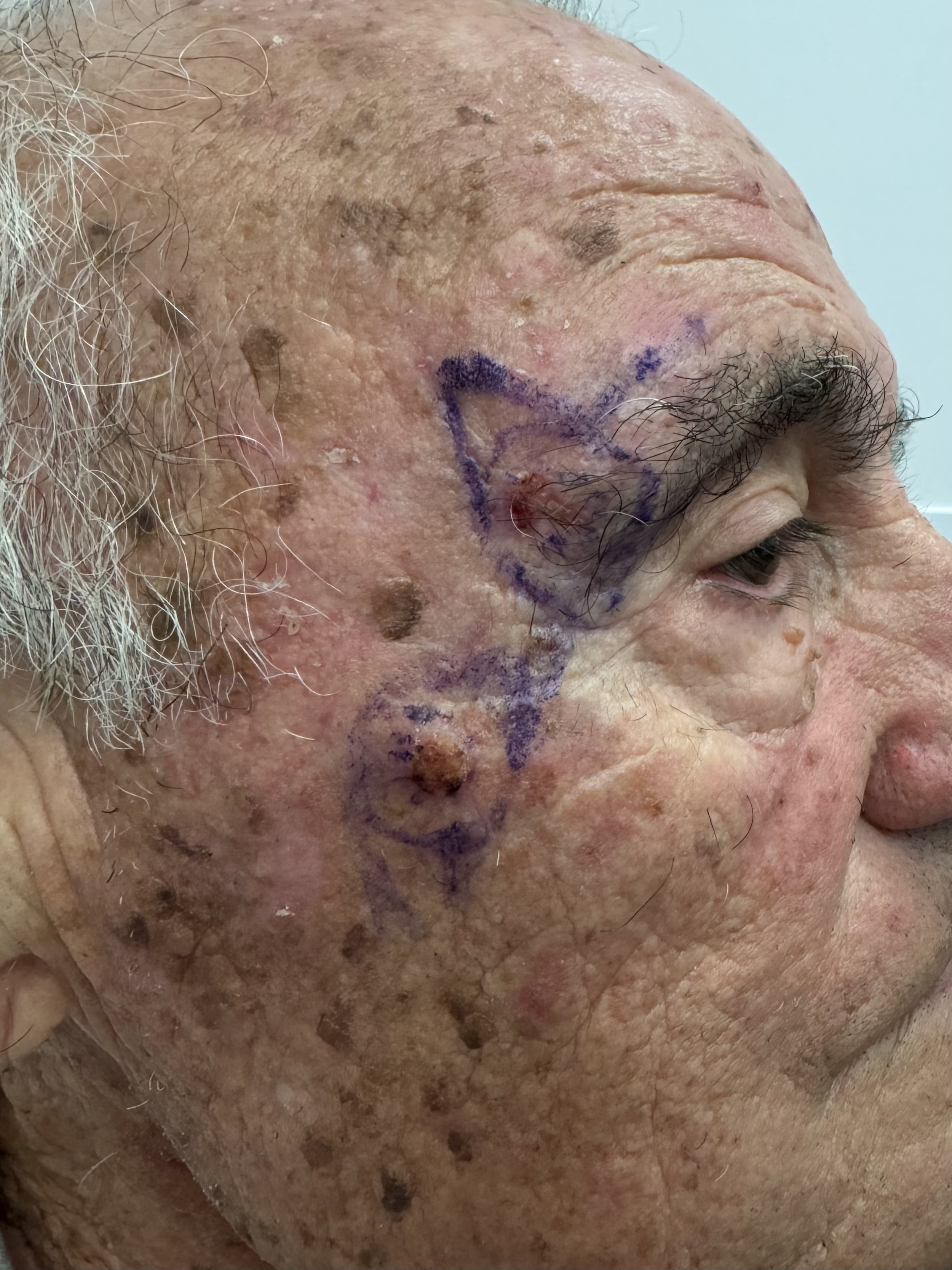 SCC of  both the right eyebrow and right cheek
