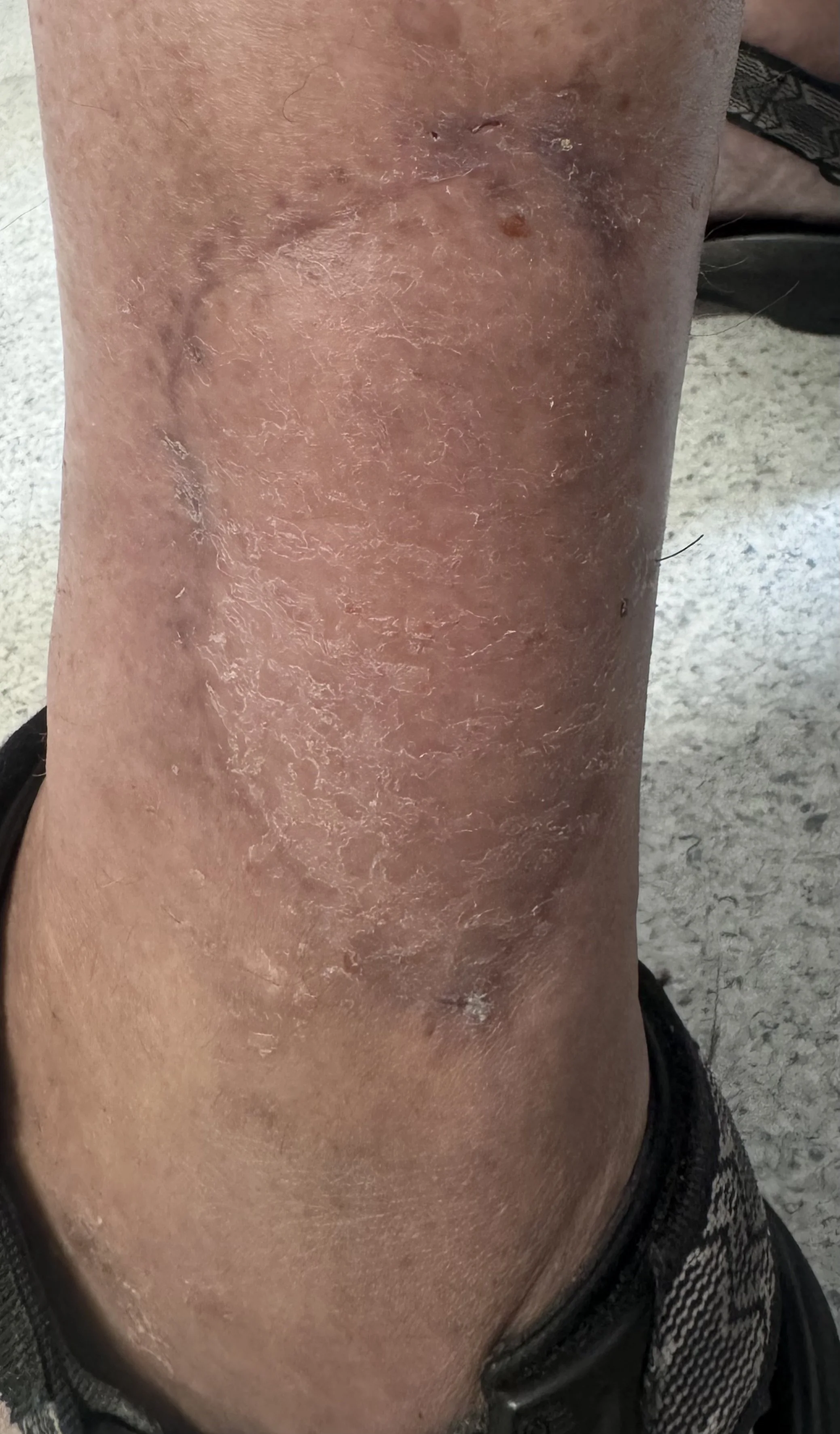 Appearance of leg 3 months after procedure
