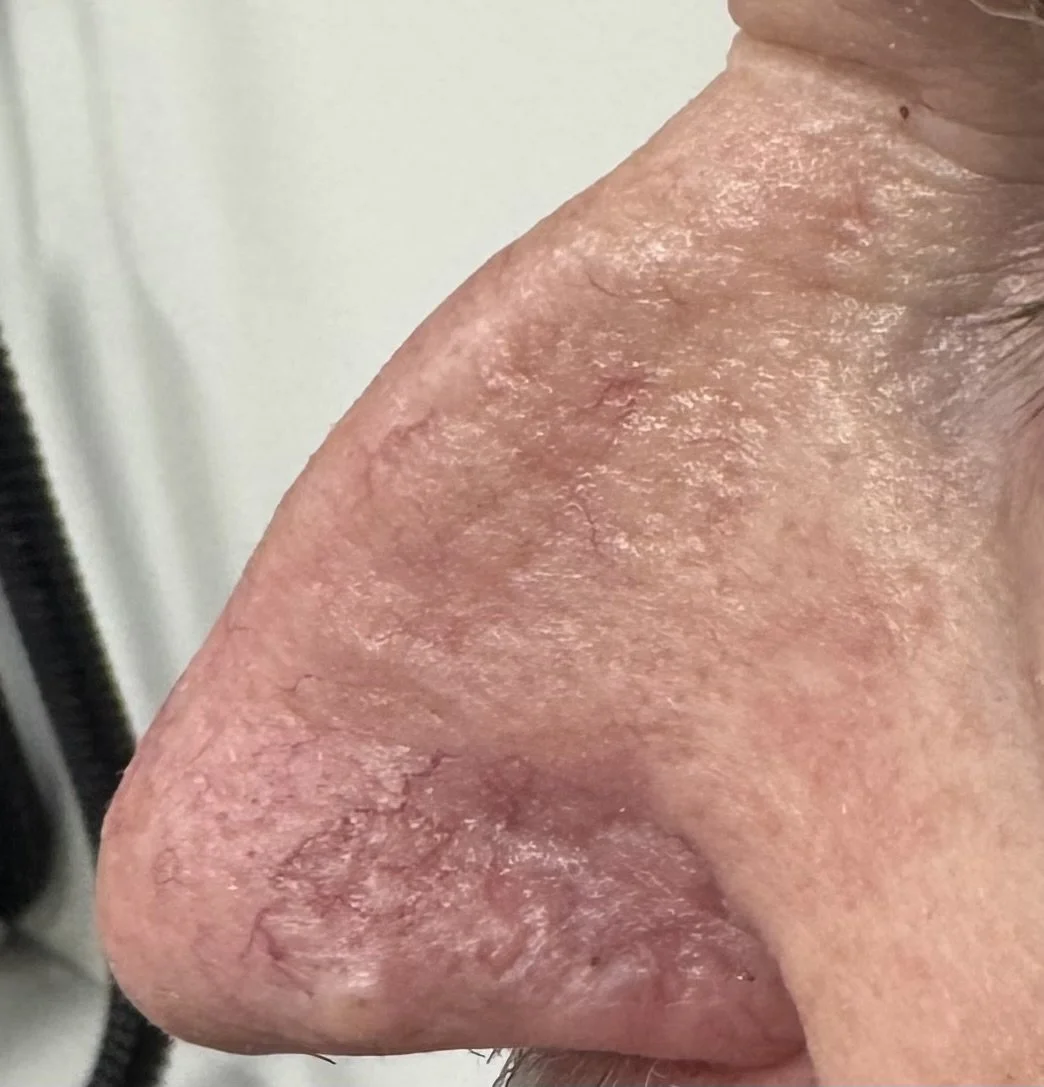4 weeks after excision of BCC and skin graft procedure