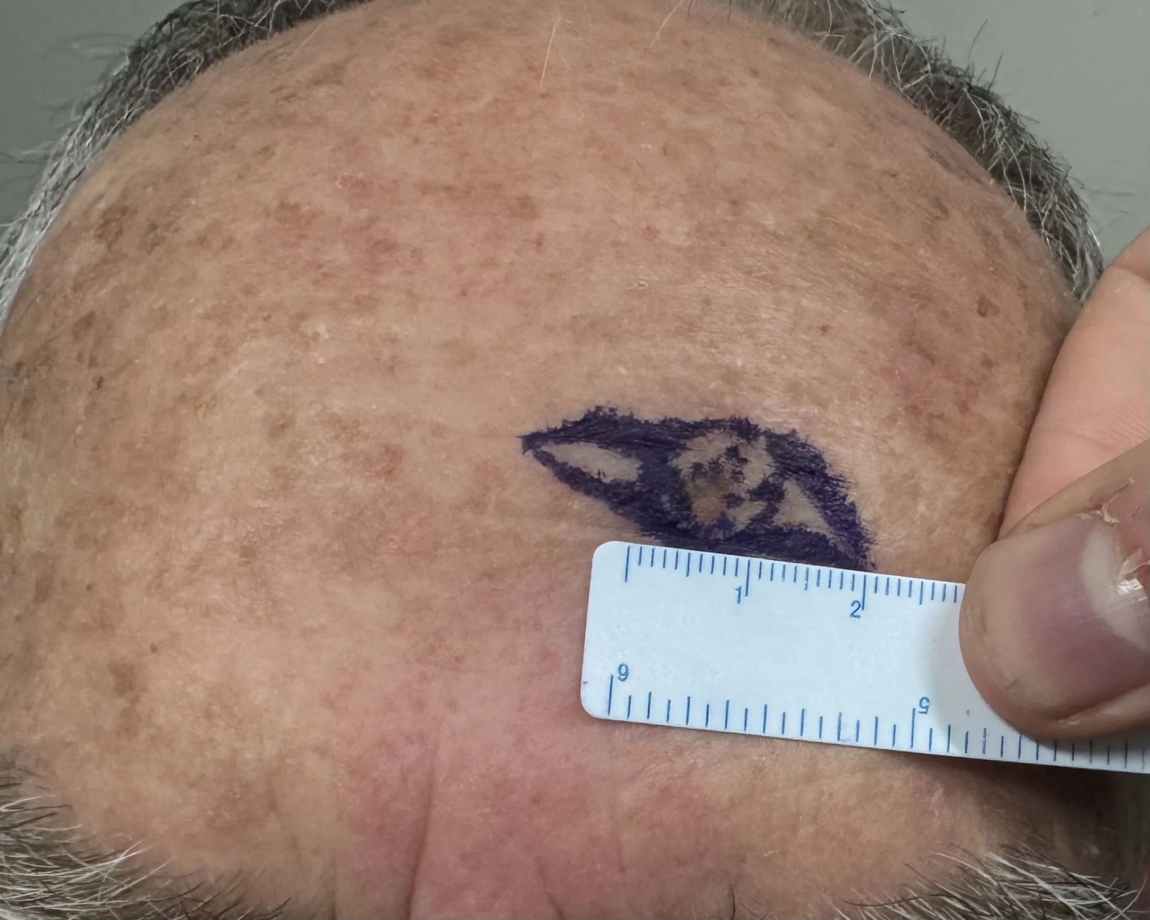 Suspicious pigmented lesion left forehead