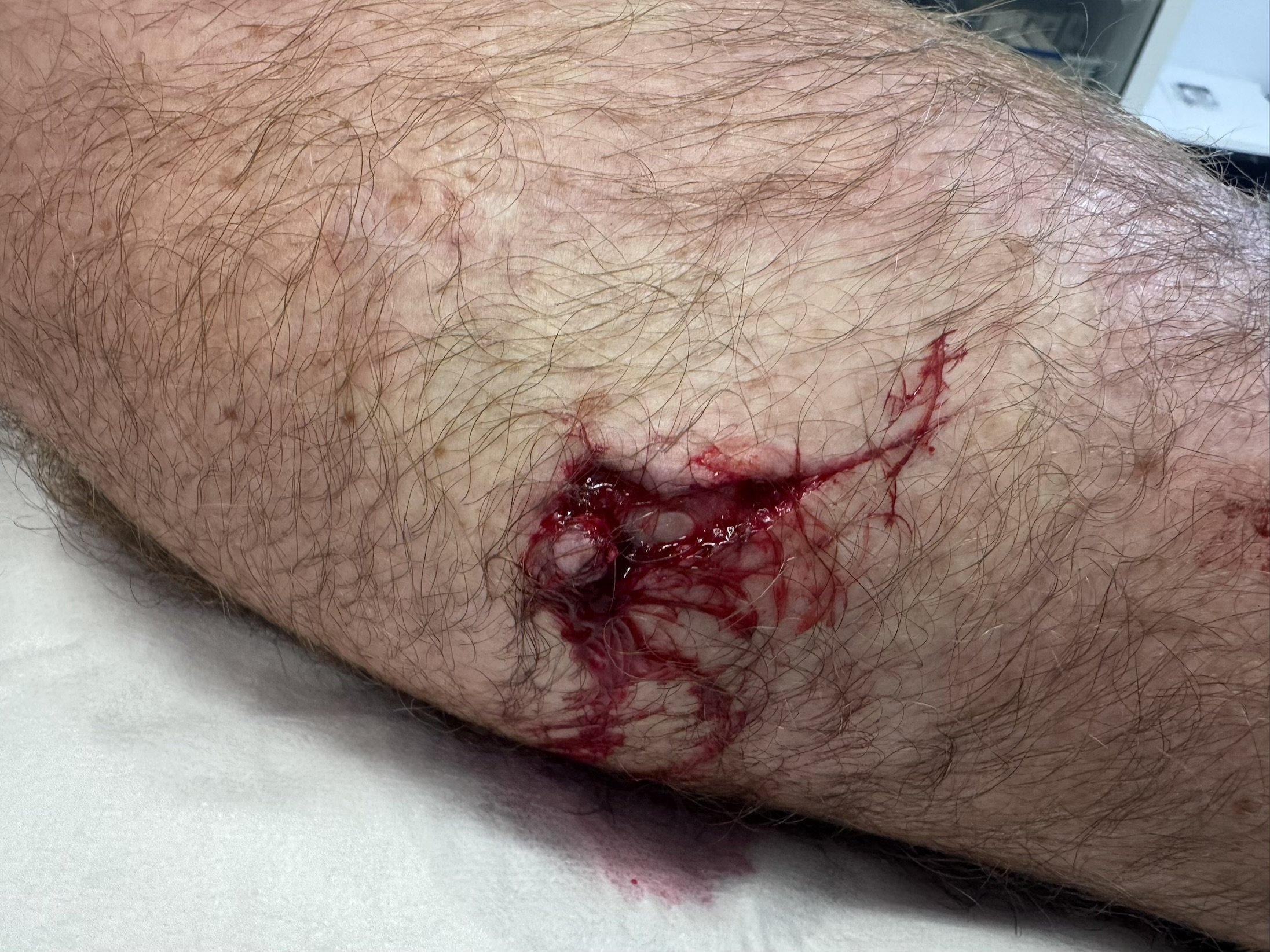Laceration of leg from injury which was subsequently explored and repaired