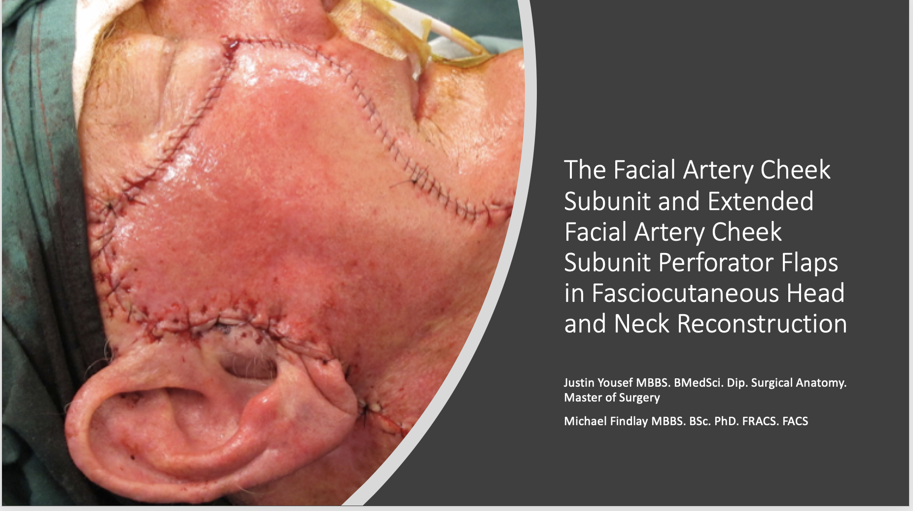 Yousef J, Findlay MW. The Facial Artery Cheek Subunit and Extended Facial Artery Cheek Subunit Perforator Flaps in Fasciocutaneous Head and Neck Reconstruction Paper presented at: Virtual Plastic Surgery The Meeting; 2020 October 16-19 (changed to vi