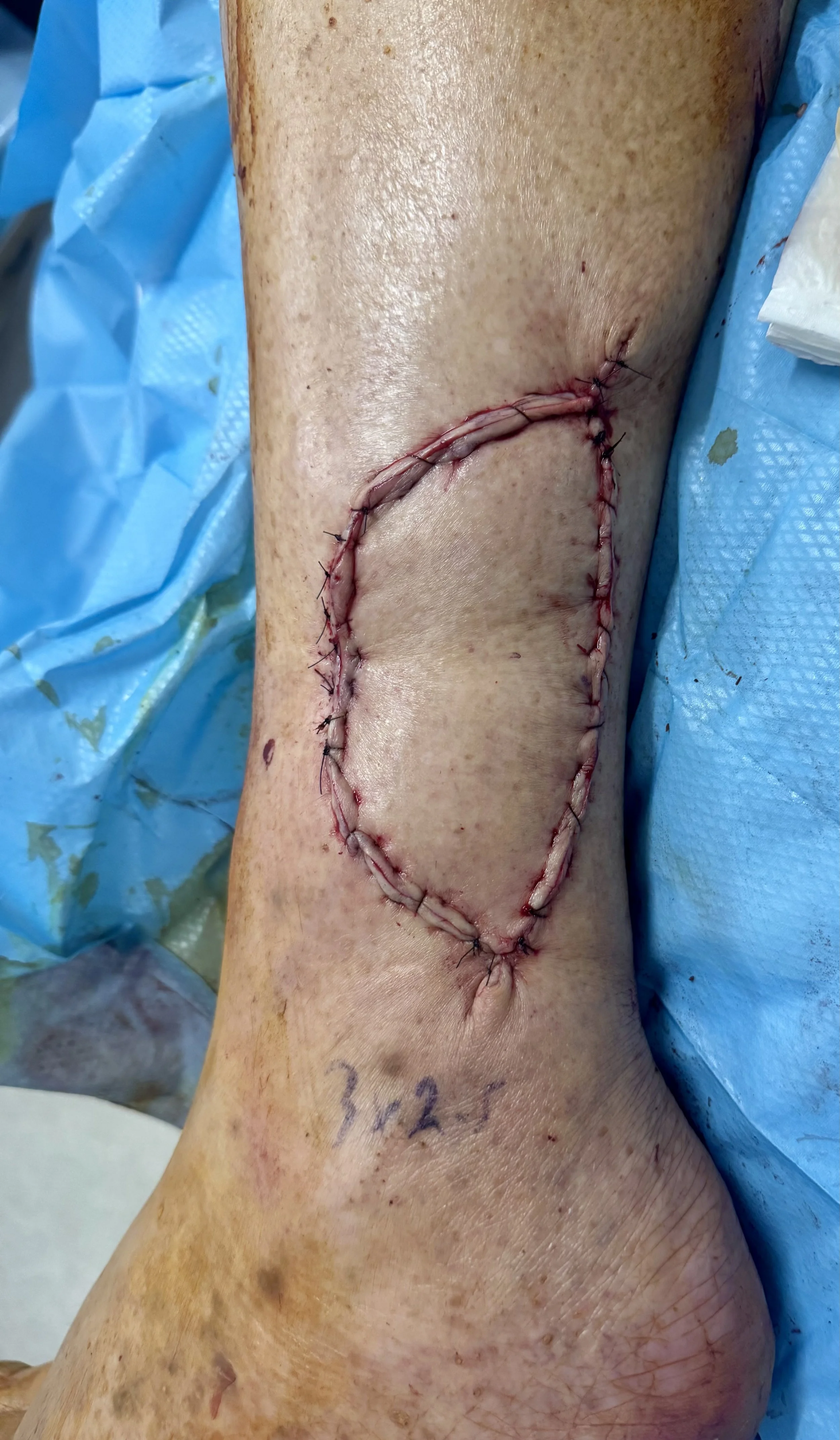 Immediate result after excision and "Keystone" flap procedure
