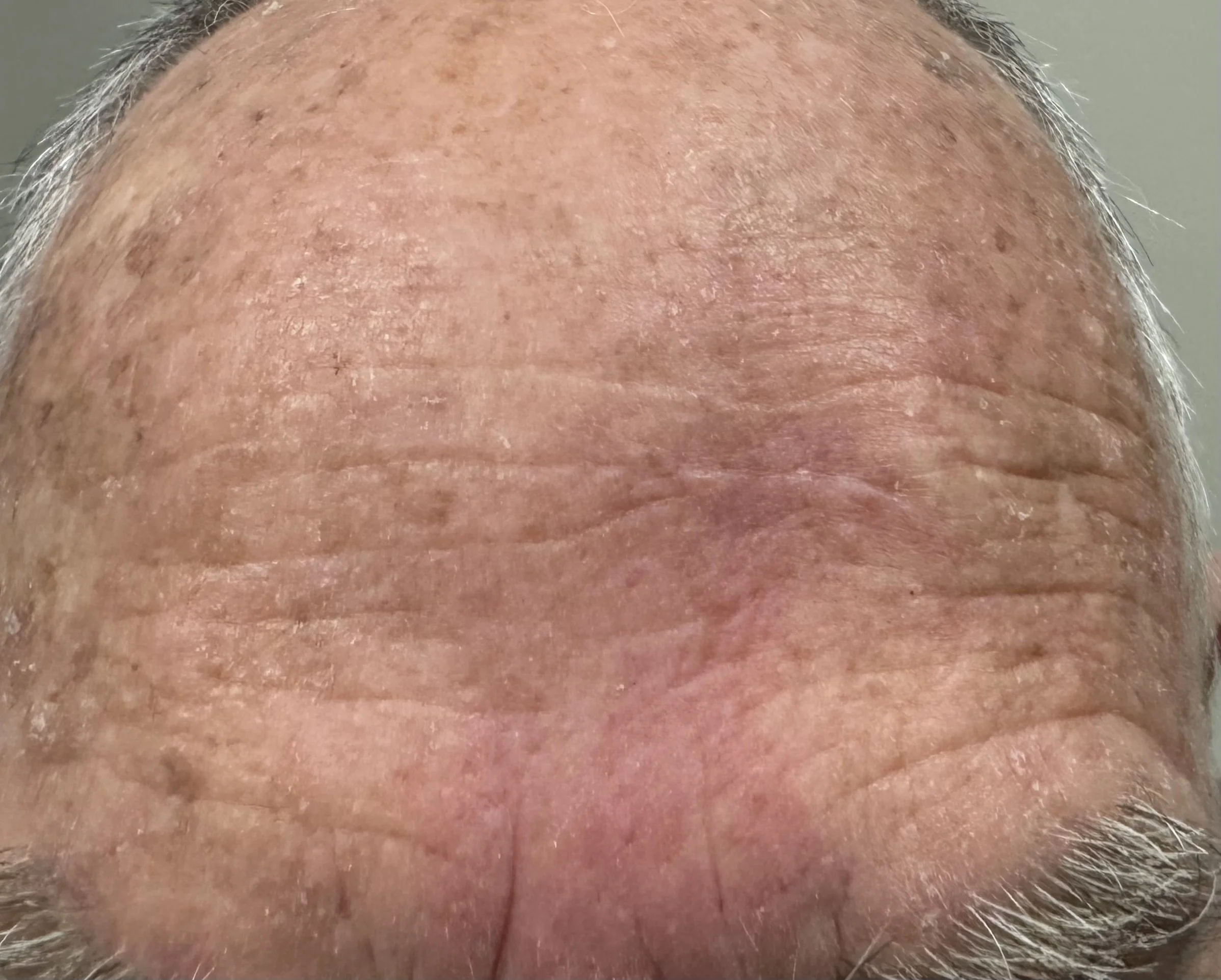Appearance of scar 1 month after excision 