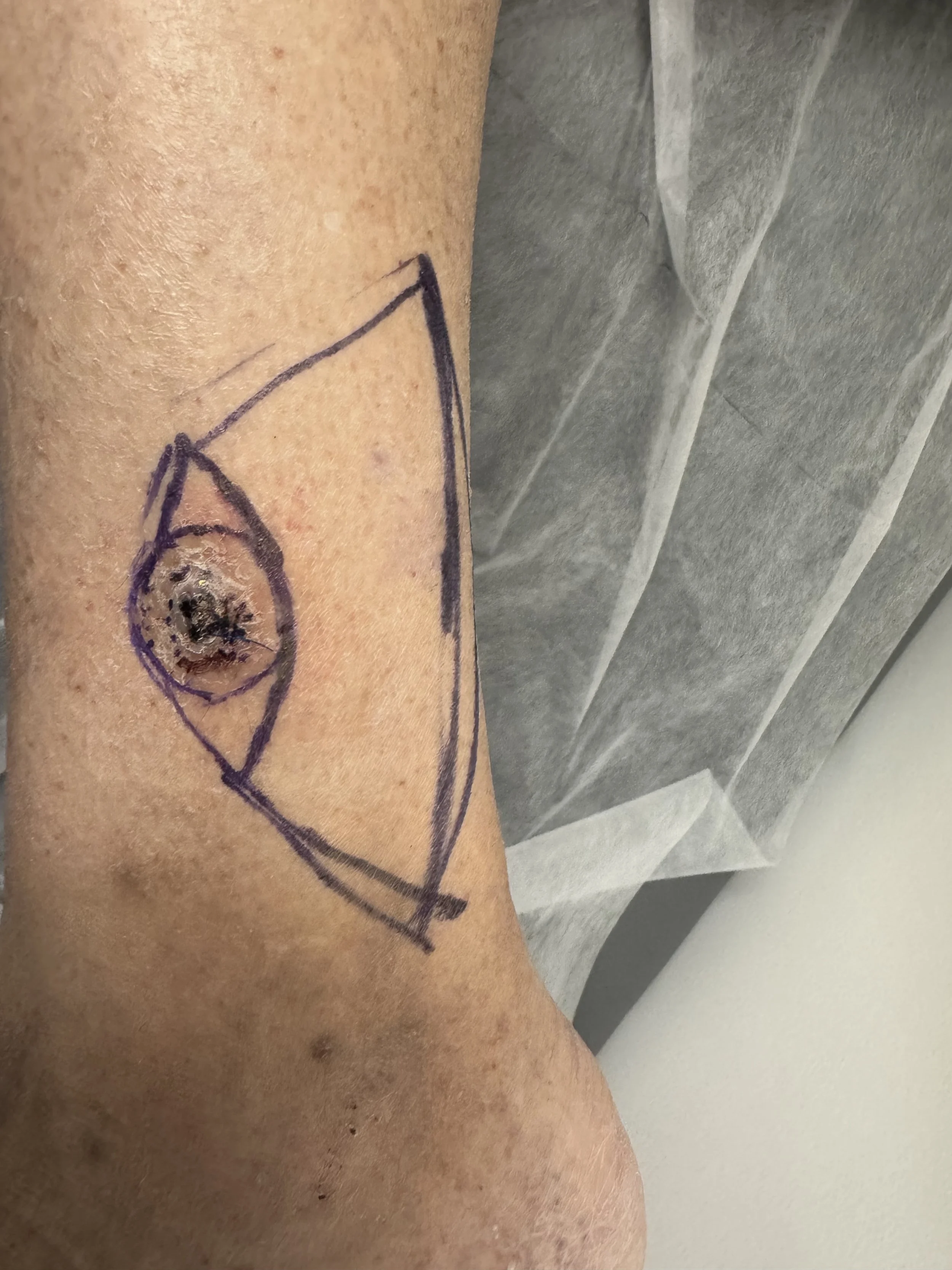 A skin cancer on a leg that, after excision, would not be possible to suture directly due to tension