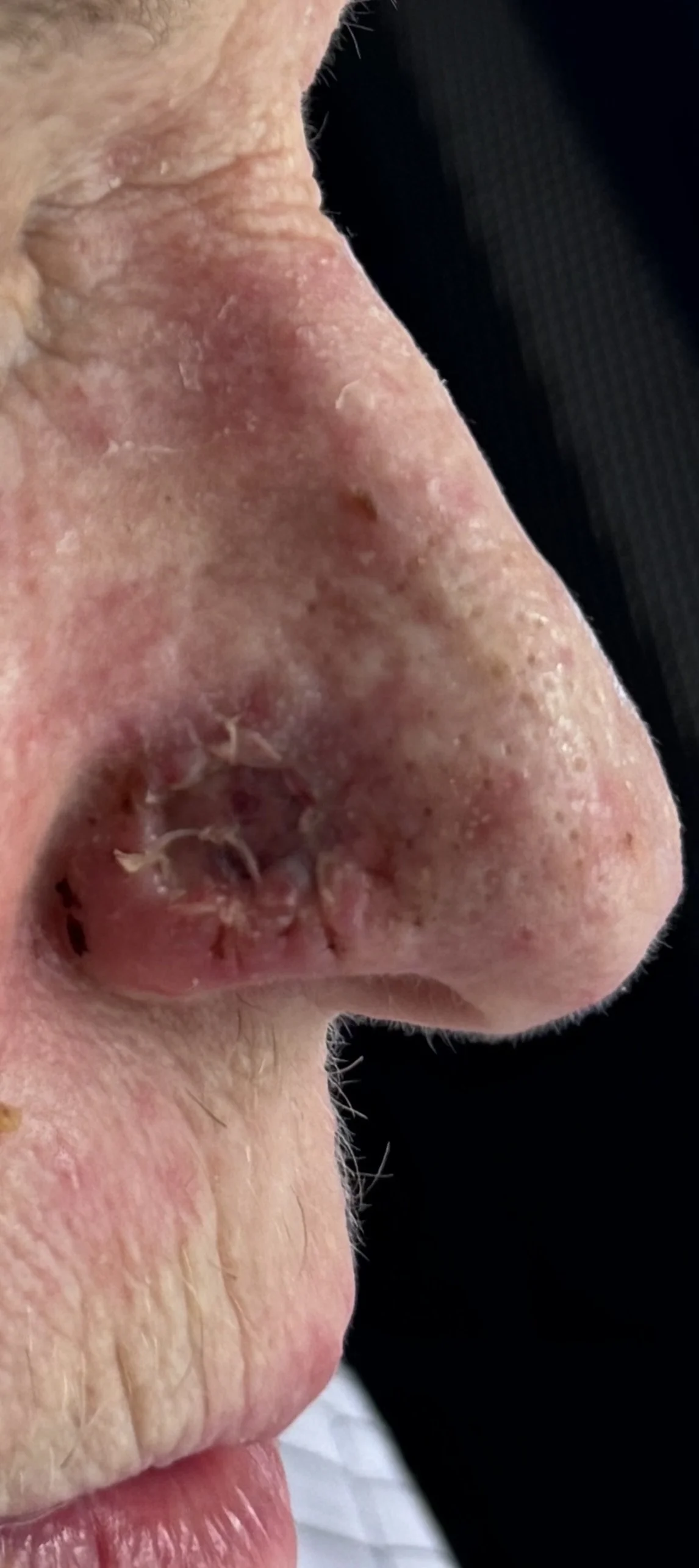 1 week after excision of BCC and skin graft