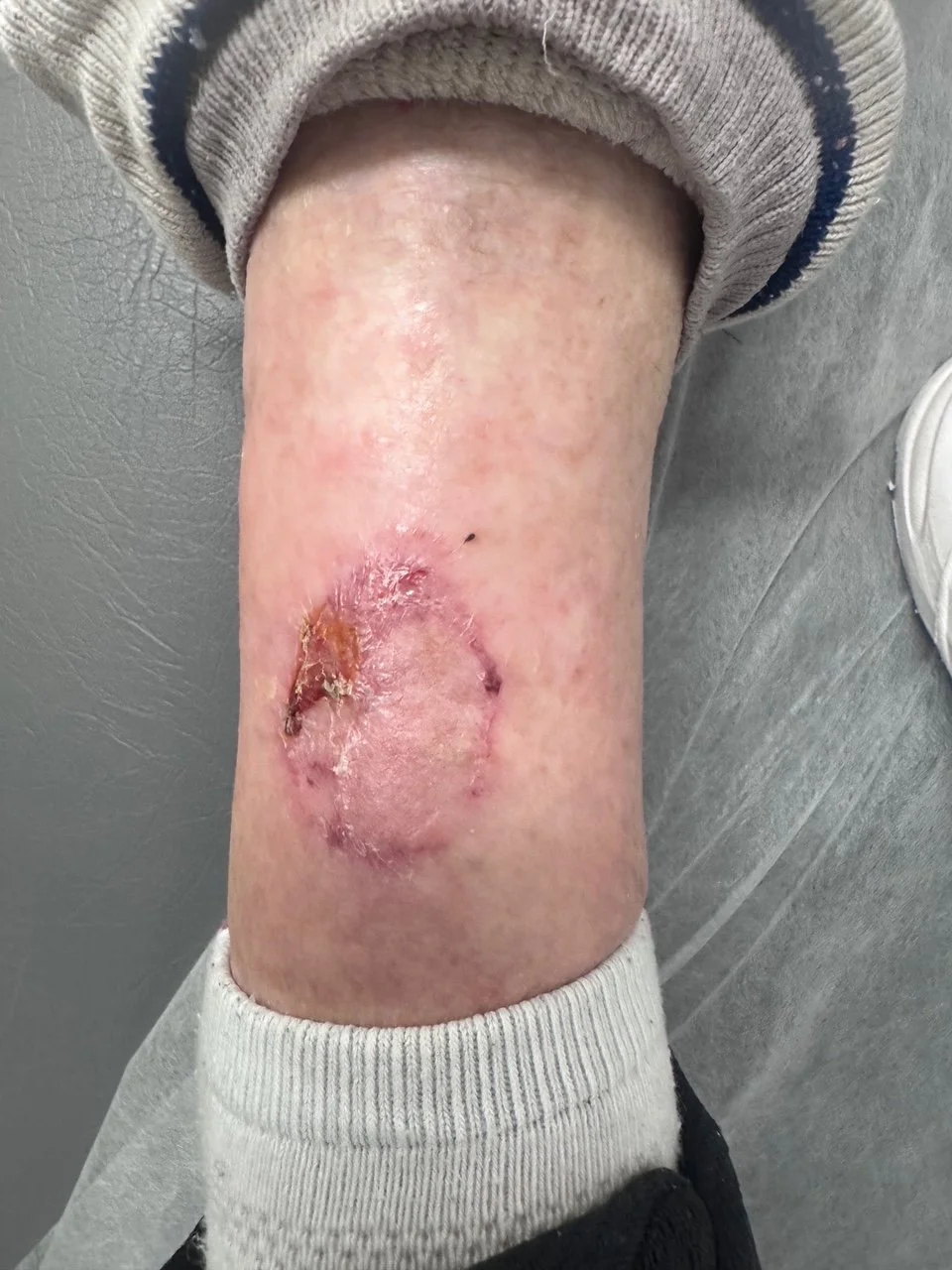 Appearance of leg 3 months after excision of skin cancer and skin graft procedure
