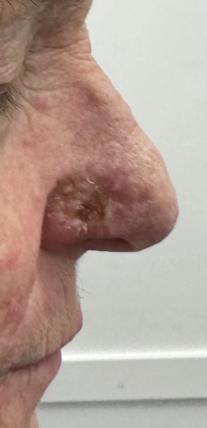 Appearance of skin graft at 2 weeks