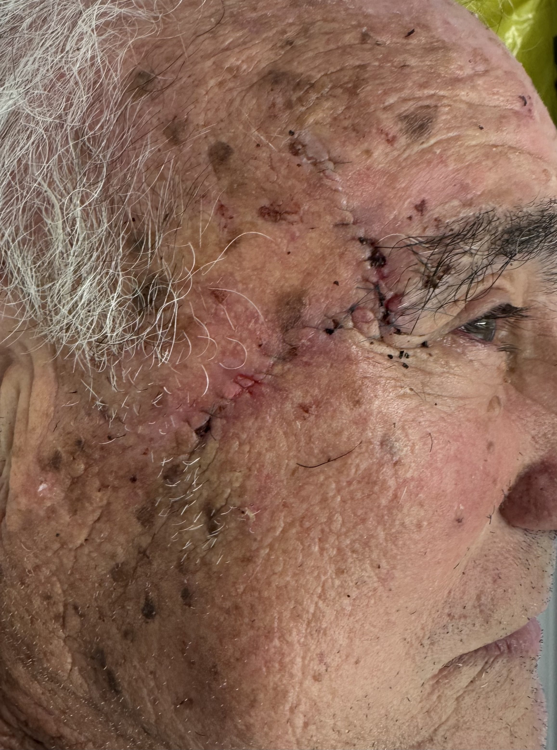 1 week after excision and local flap procedure