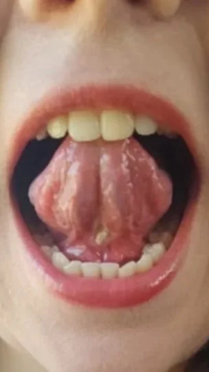 Ankyloglossia (rövid nyelvfék) frenectomia után gyógyult állapotban – javult nyelvmozgás és funkcionális nyelvfék-korrekciót követő eredmény.