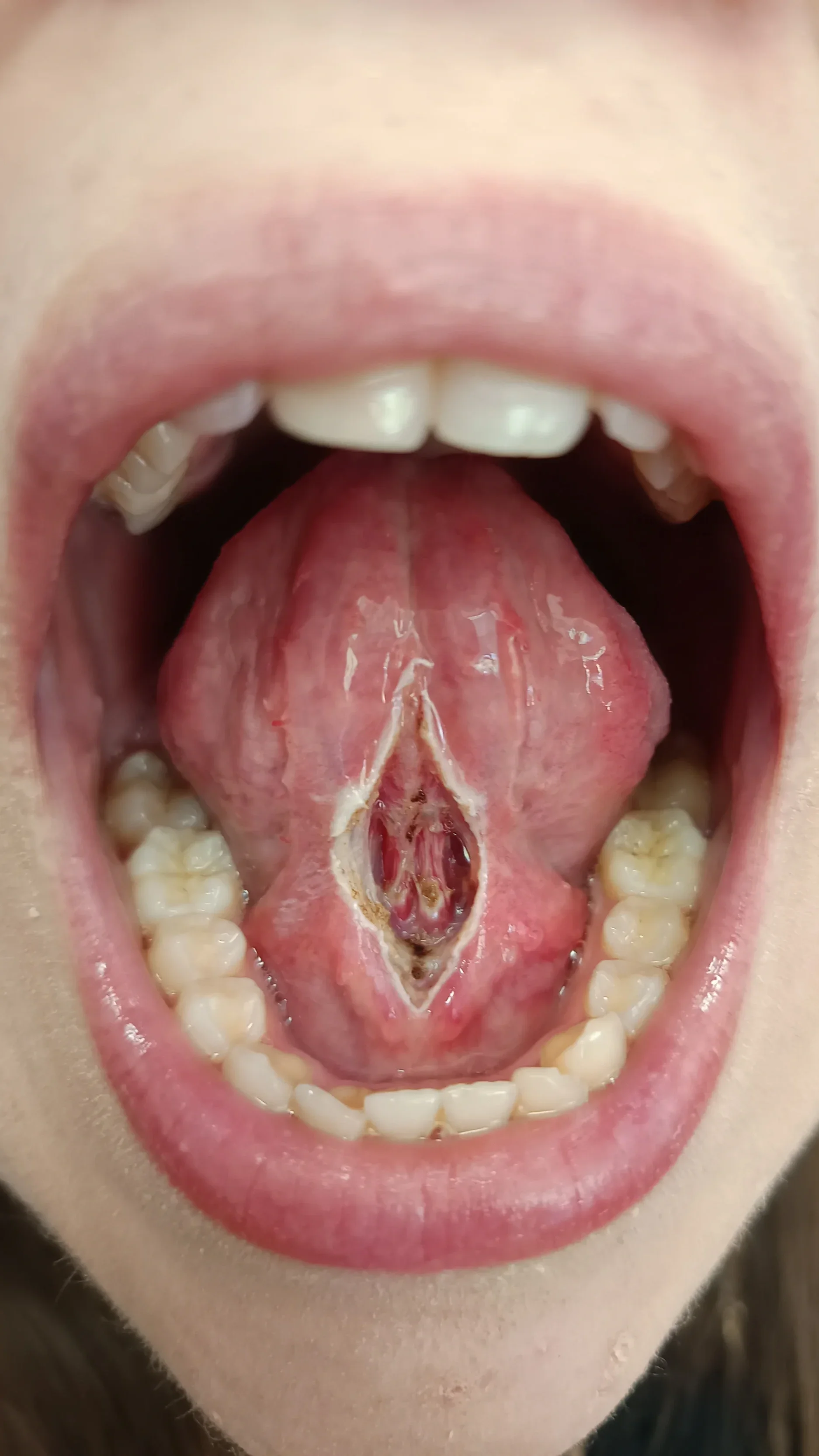 Ankyloglossia (feszes nyelvfék) közvetlenül frenectomia után – nyelvfék korrekciót követő állapot és a nyelv mozgástartományának javulása.