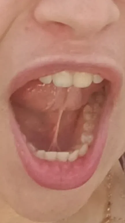 Ankyloglossia (rövid nyelvfék) frenectomia előtt – feszes nyelvfék funkcionális vizsgálata és nyelvmozgás-korlátozottság gyermek- és felnőttkorban.