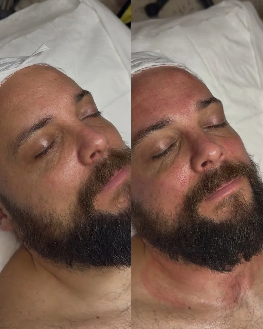 🎯 Client&rsquo;s Objective: Improve the look of acne scars, smooth, brighten, refine pores and reduce signs of ageing 💪🏽

SKIN FITNESS PLAN 
&bull;Treatment Plan: Our Pro Microneedling Programme- 3 treatments, 4 weeks apart. *PHOTO IMMEDIATELY pos