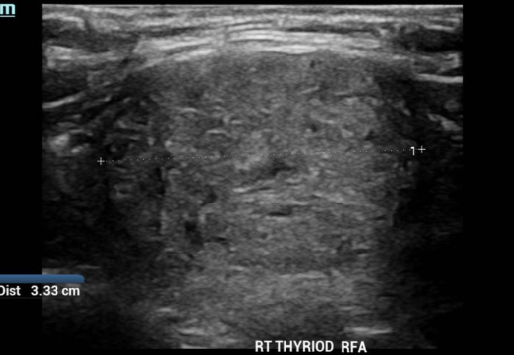 Ultrasound image of the right thyroid gland with a measurement of 3.33 cm.