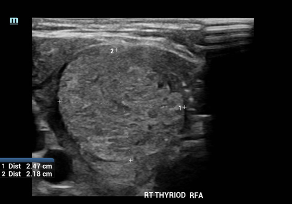 Ultrasound image of a right thyroid with measurements showing 2.47 cm and 2.18 cm.