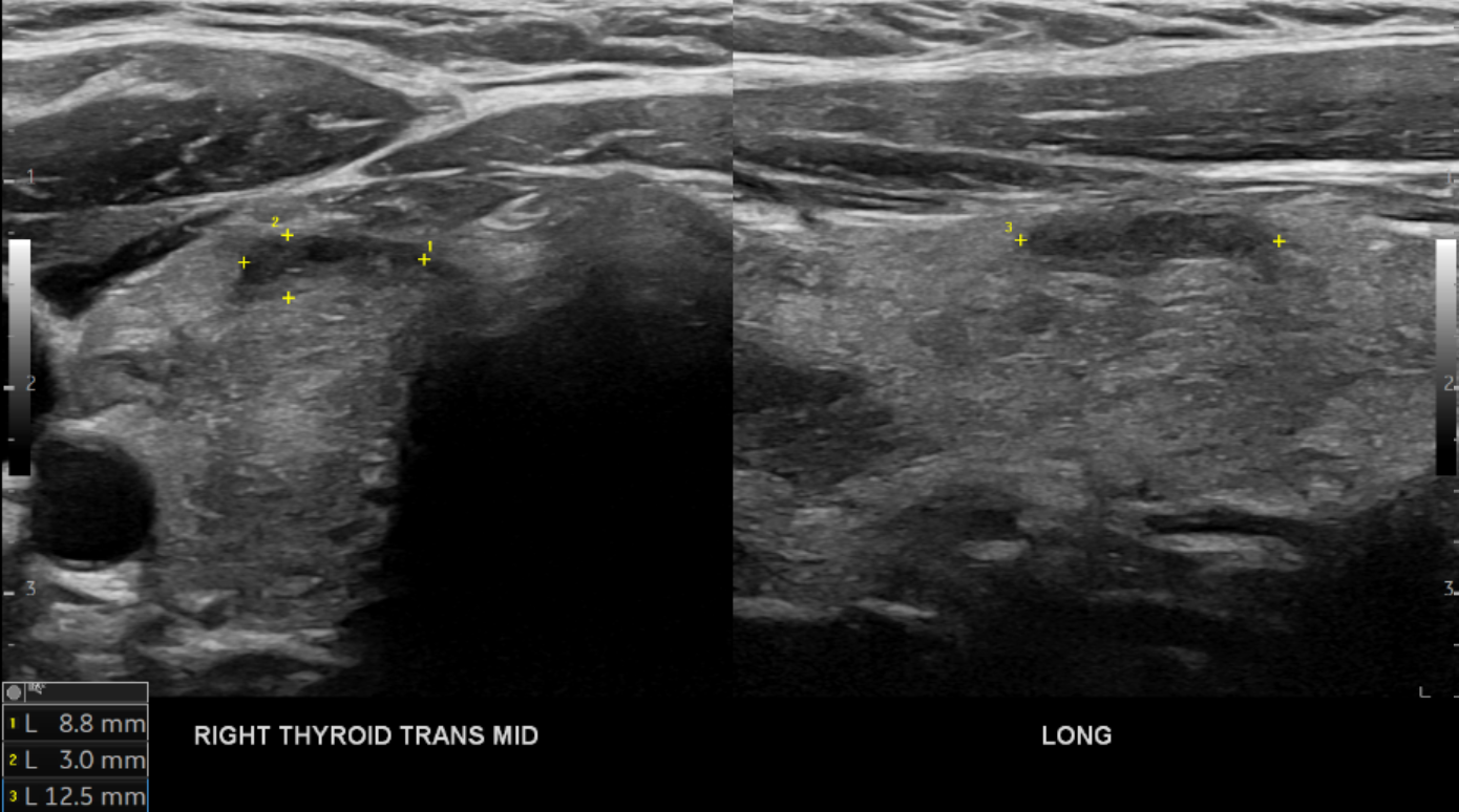 Ultrasound image showing a cross-section of the right thyroid gland, with measurements indicating size in millimeters.