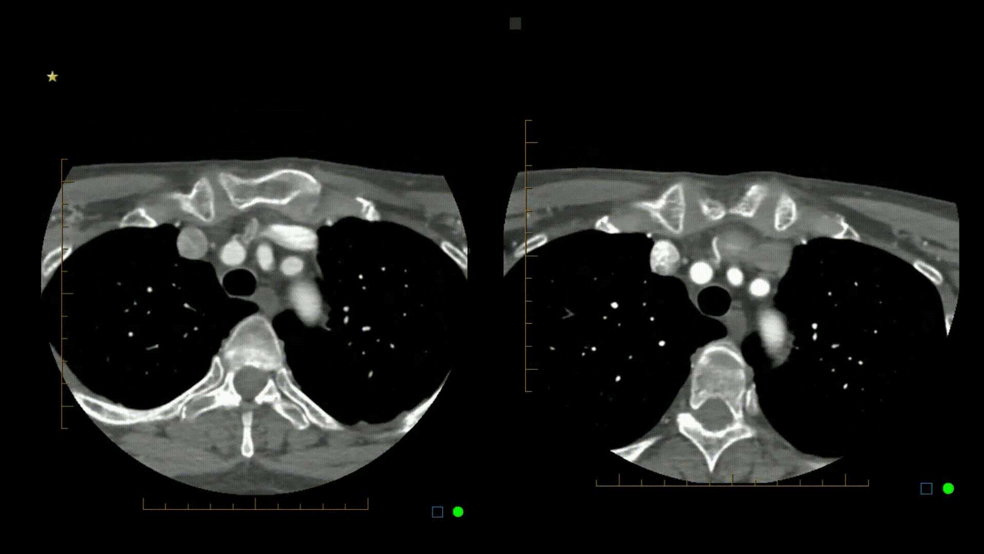 Pre and post contrast CT scans after thyroid embolisation.