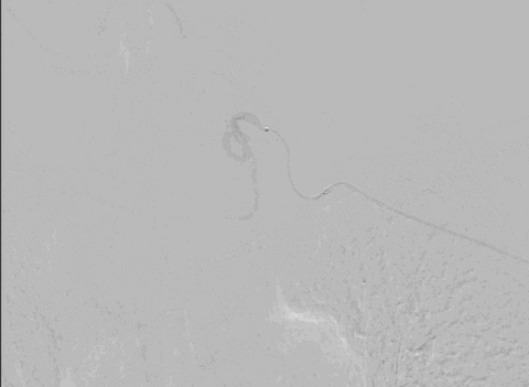 Angiogram showing marked blush in the thyroid prior to a thyroid artery embolisation being performed.