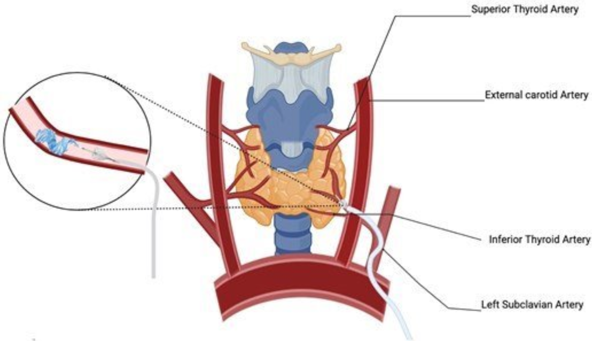 Diagram showing the thyroid artery embolisation procedure.