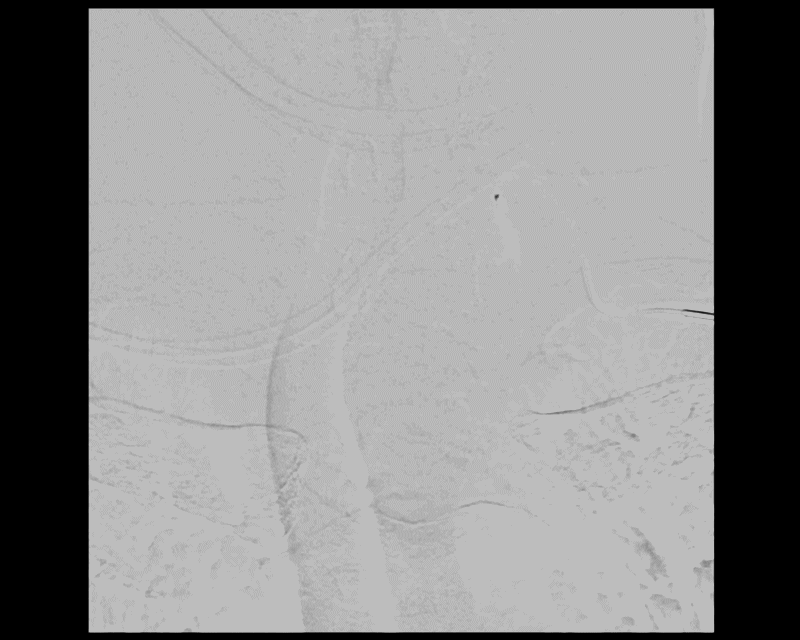Post embolisation angiogram showing successful devascularisation.