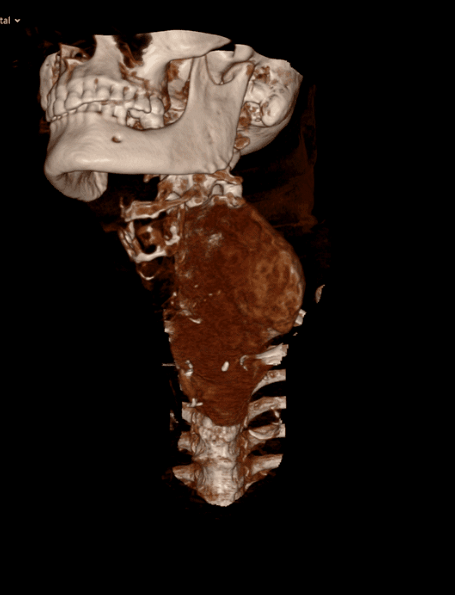 3D medical scan image of a human neck and upper chest showing internal bones and a large tumor in the throat area.