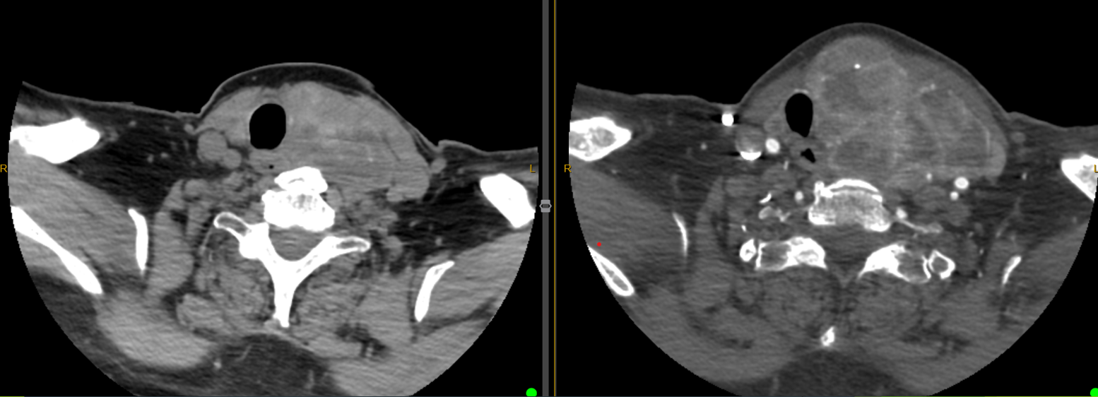 Precontrast CT showing a large left lobe nodule.