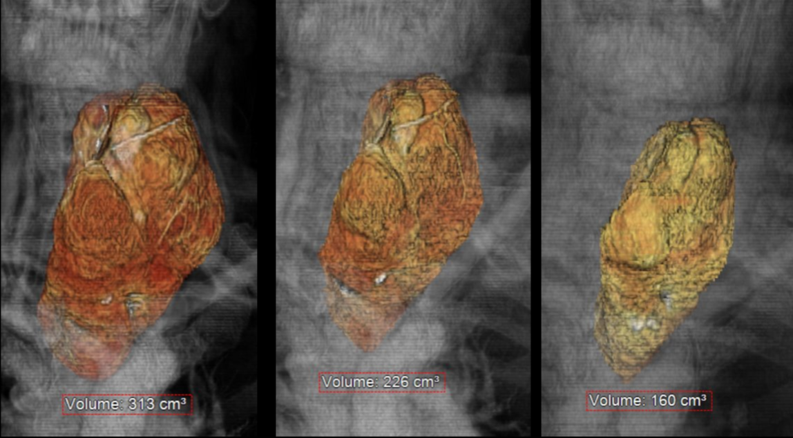 Three 3D images of the thyroid nodule showing different volumes: 313 cm³, 226 cm³, and 160 cm³ post embolisation.
