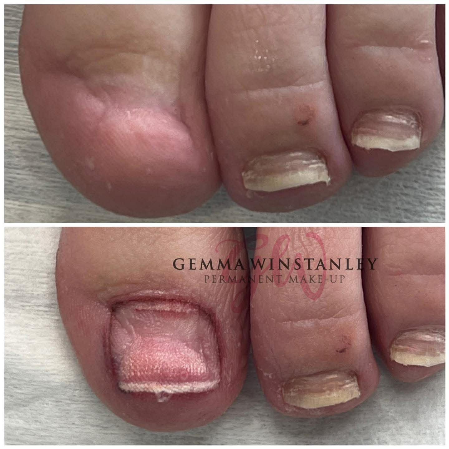 Close-up of toenails before and after a permanent makeup treatment, showing the transformation of the toenail appearance.